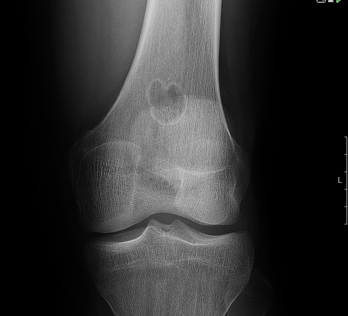 Киста бедренной. Аневризматическая костная киста бедренной кости на рентгене. Костная киста большеберцовой кости. Солитарная киста бедренной кости рентген. Аневризматическая костная киста большеберцовой кости.