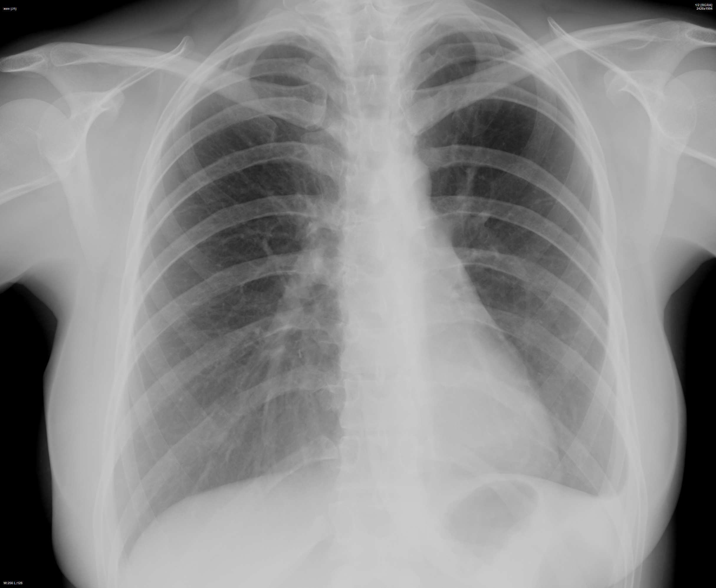 Милиарный туберкулез рентген