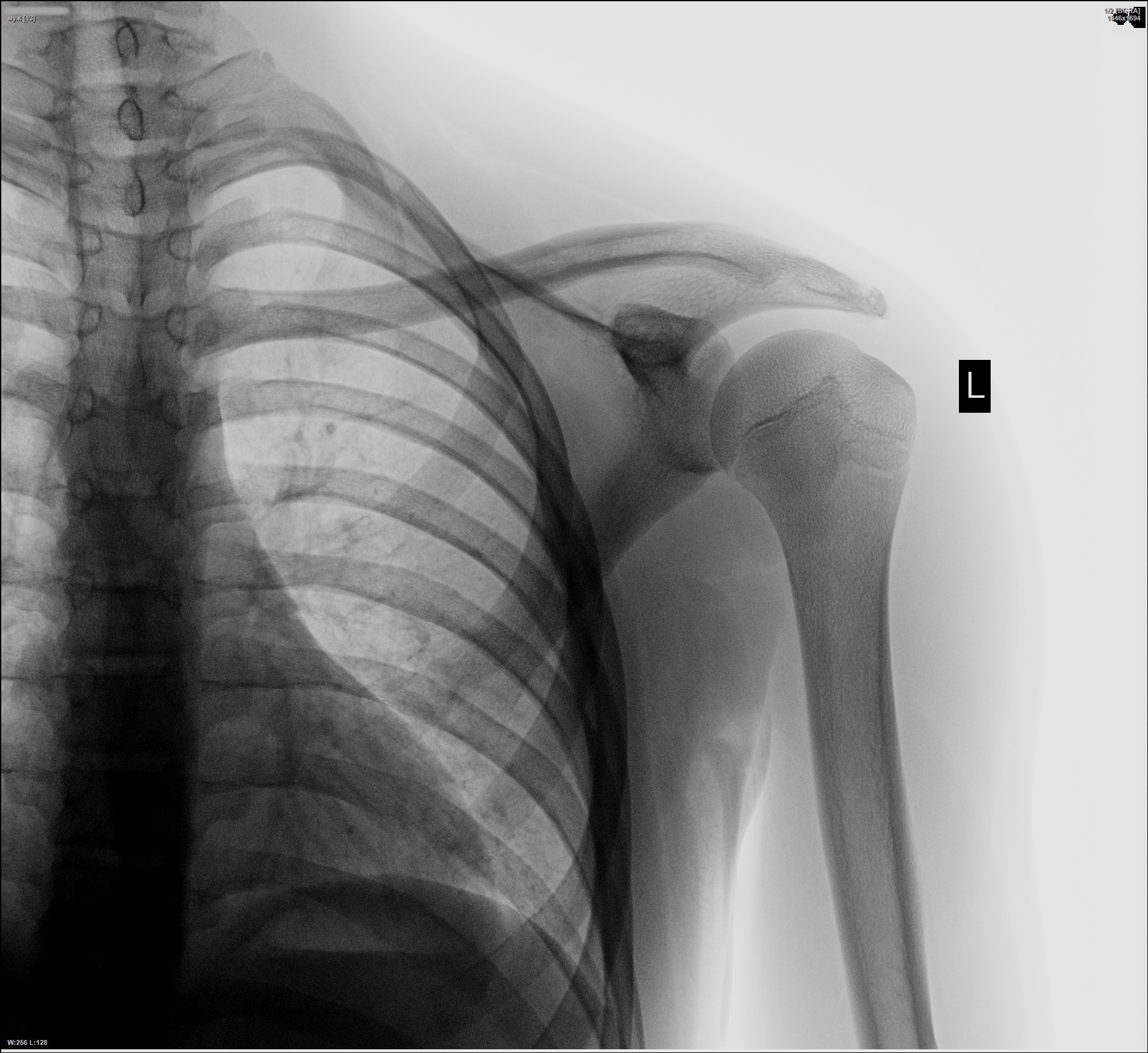 Головчатое возвышение плечевой кости у детей на рентгене