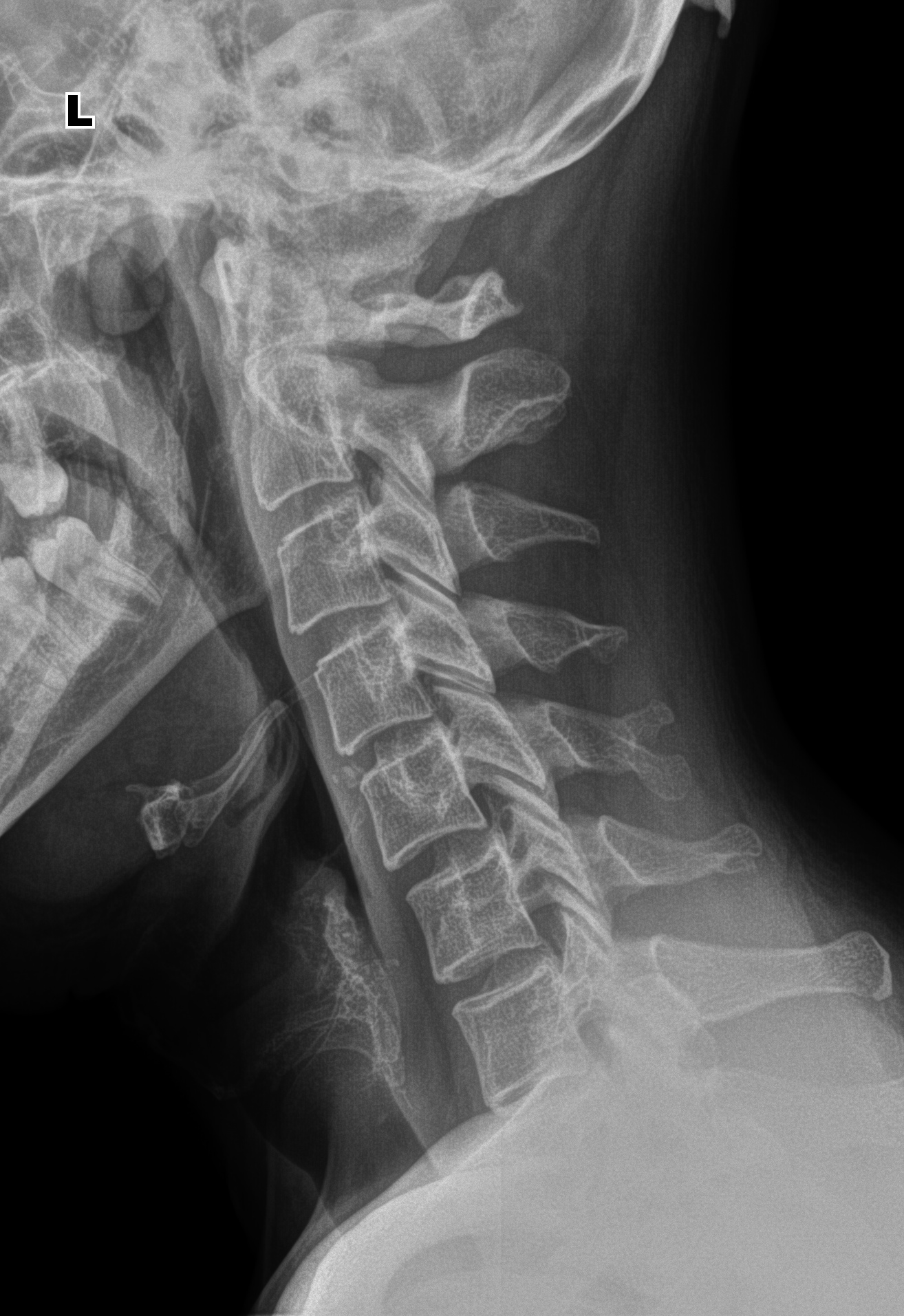Шейный отдел позвоночника рентген. Дисторсия шейного отдела позвоночника рентген. Обызвествление щитовидного хряща на рентгене. Шейный отдел рентген кальцинаты.