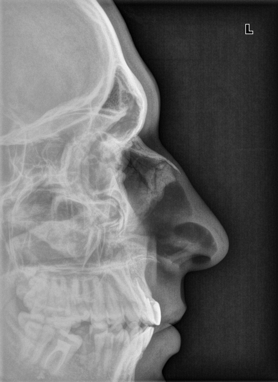 Оскольчатый перелом костей носа на рентгене