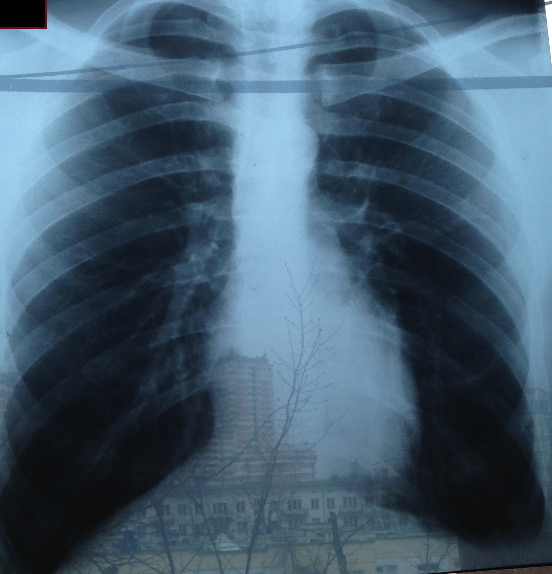 Рентген легких с пневмонией фото у детей