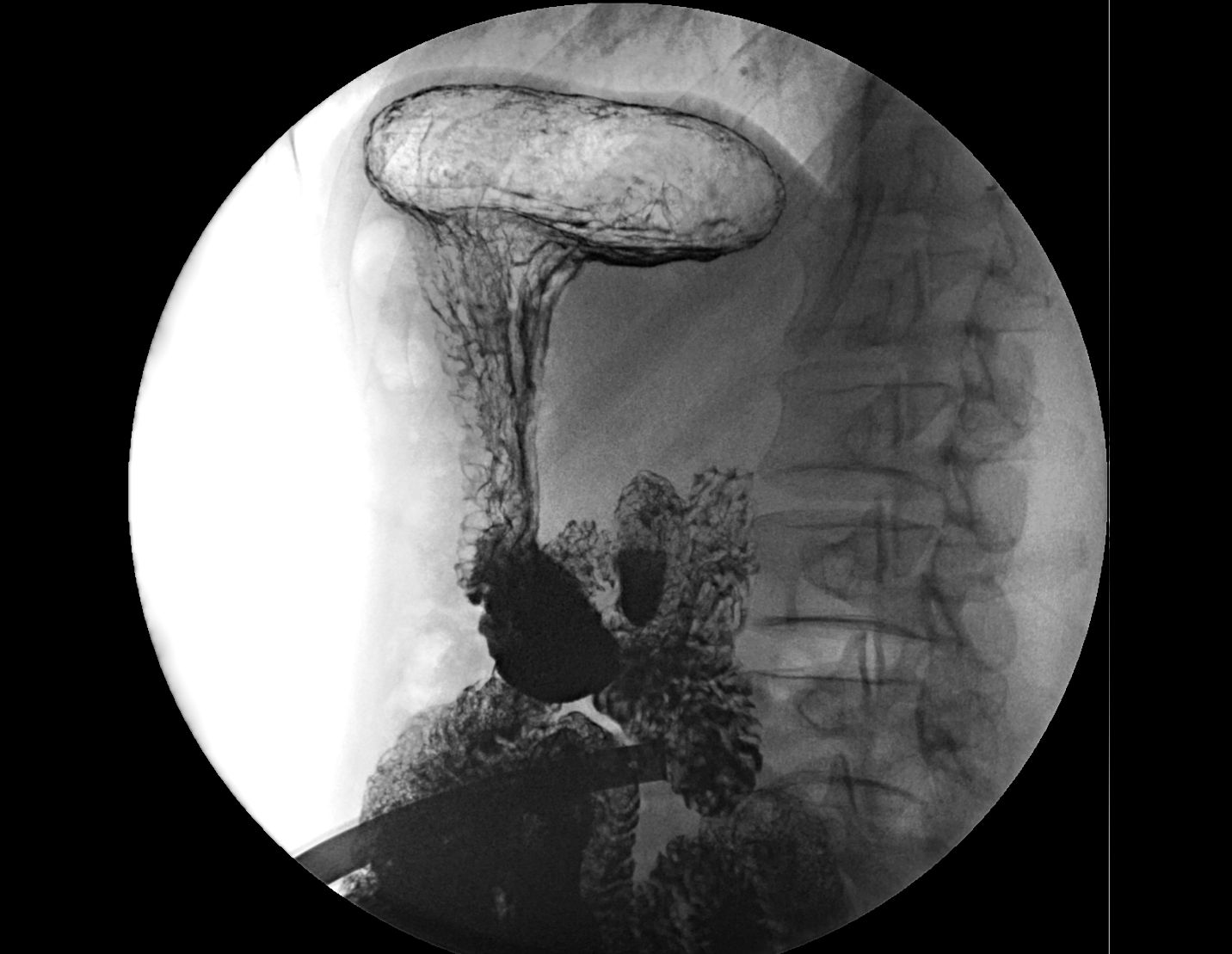 Рентгеноскопия желудка