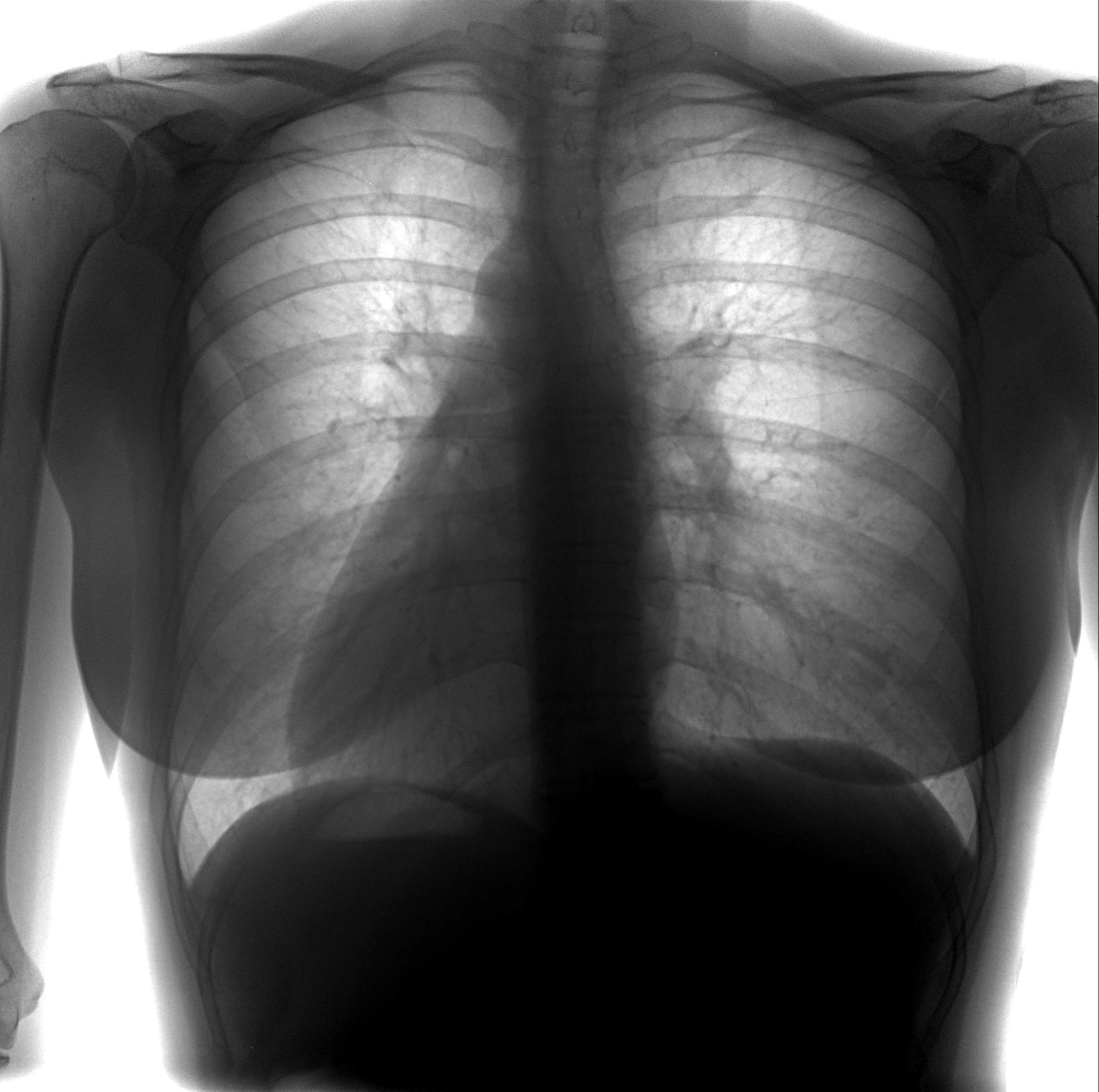Рентген легких норма и патология фото