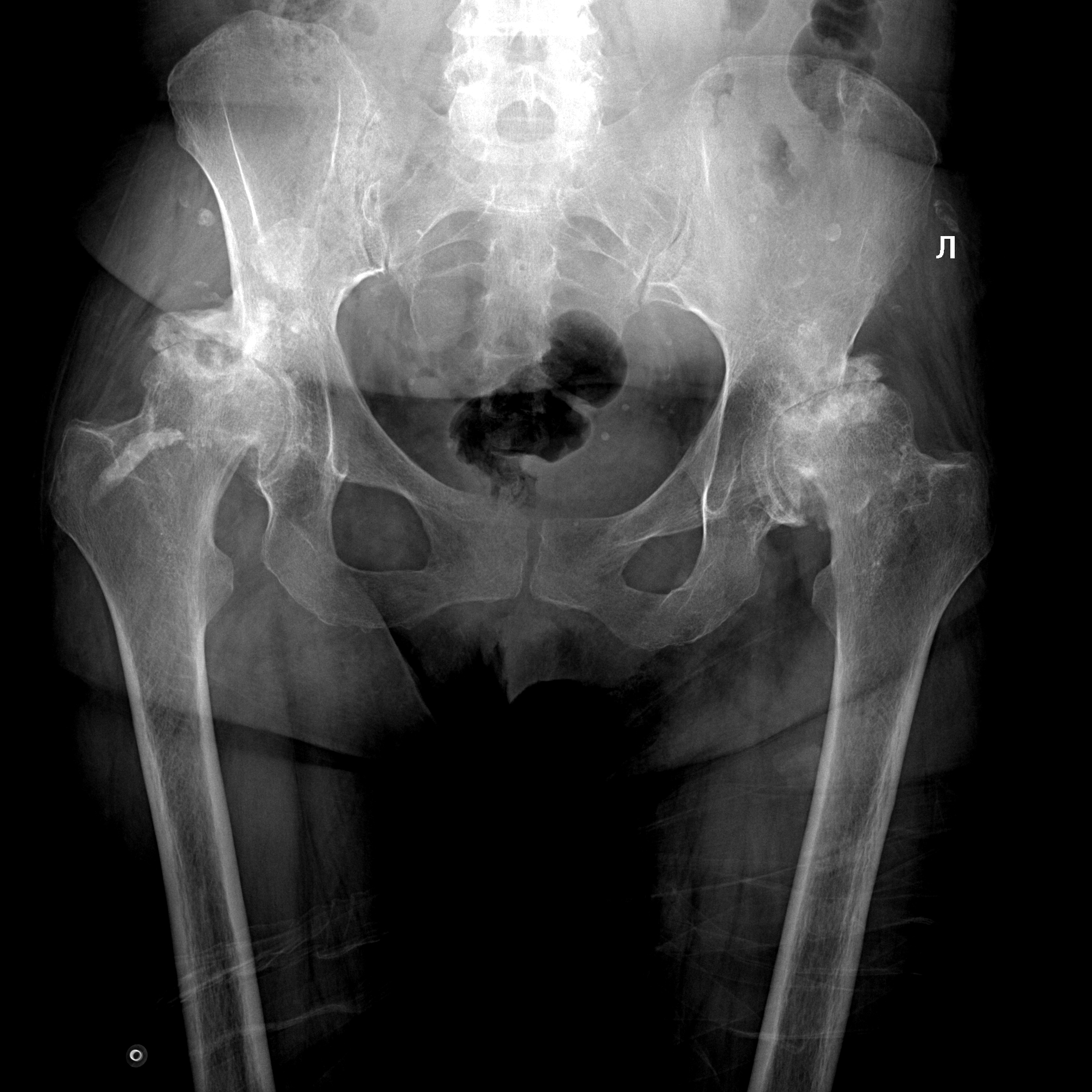 Что такое тбс. Рентген коксартроза ТБС 1 степени. R-гр обоих тазобедренных суставов.