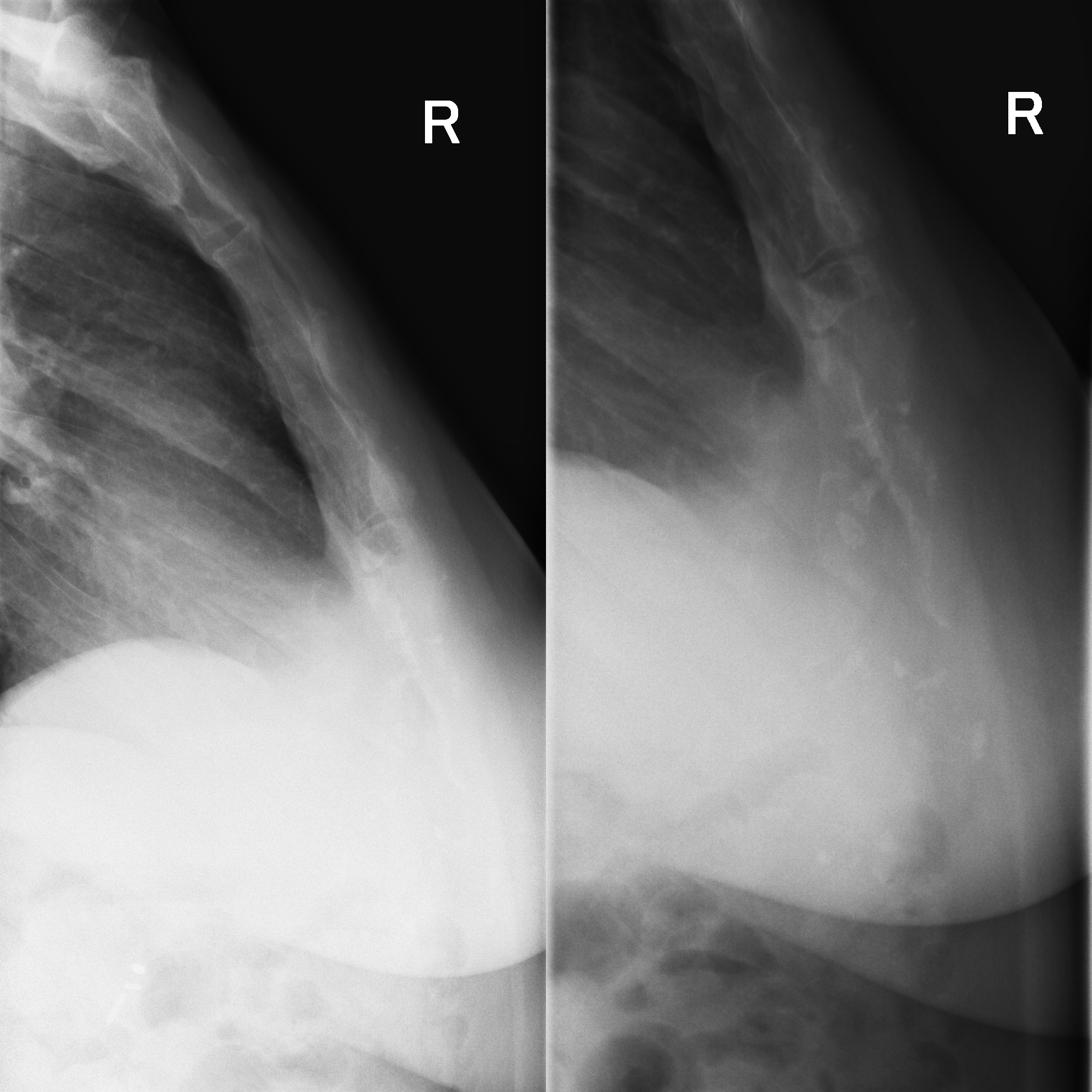 Перелом рукоятки грудины рентген