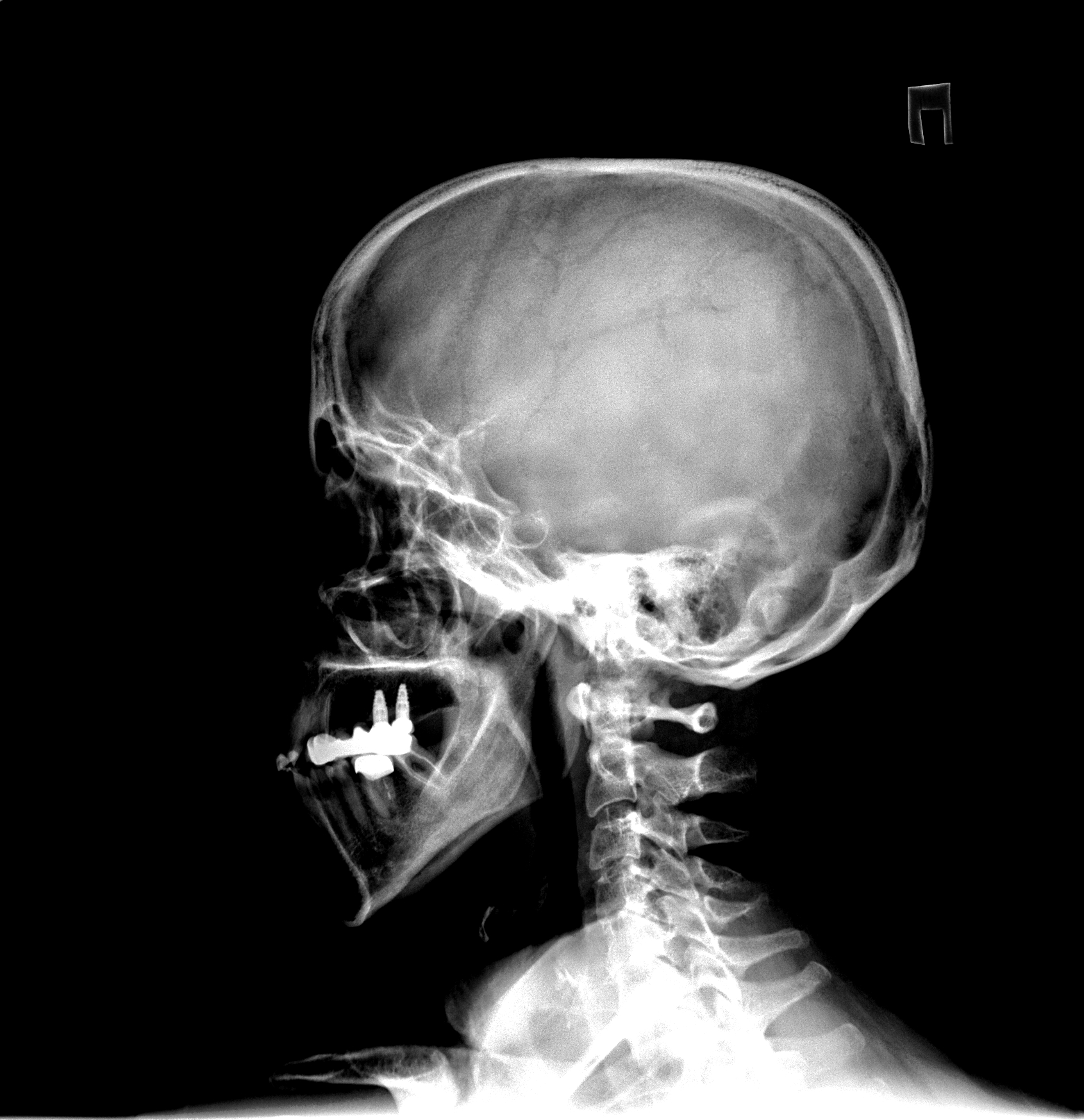 Травмы черепа и головного мозга. Черепно-мозговая травма рентген. Перелом головы рентген. Закрытая черепно мозговая травма рентген.