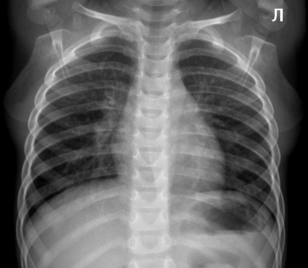 Рентген снимки детей. Рентген здорового ребенка грудной клетки пневмония. Снимок здоровых легких у ребенка на рентгене. Обзорный рентген грудной клетки пневмония. Рентгенограмма грудной клетки пневмония.