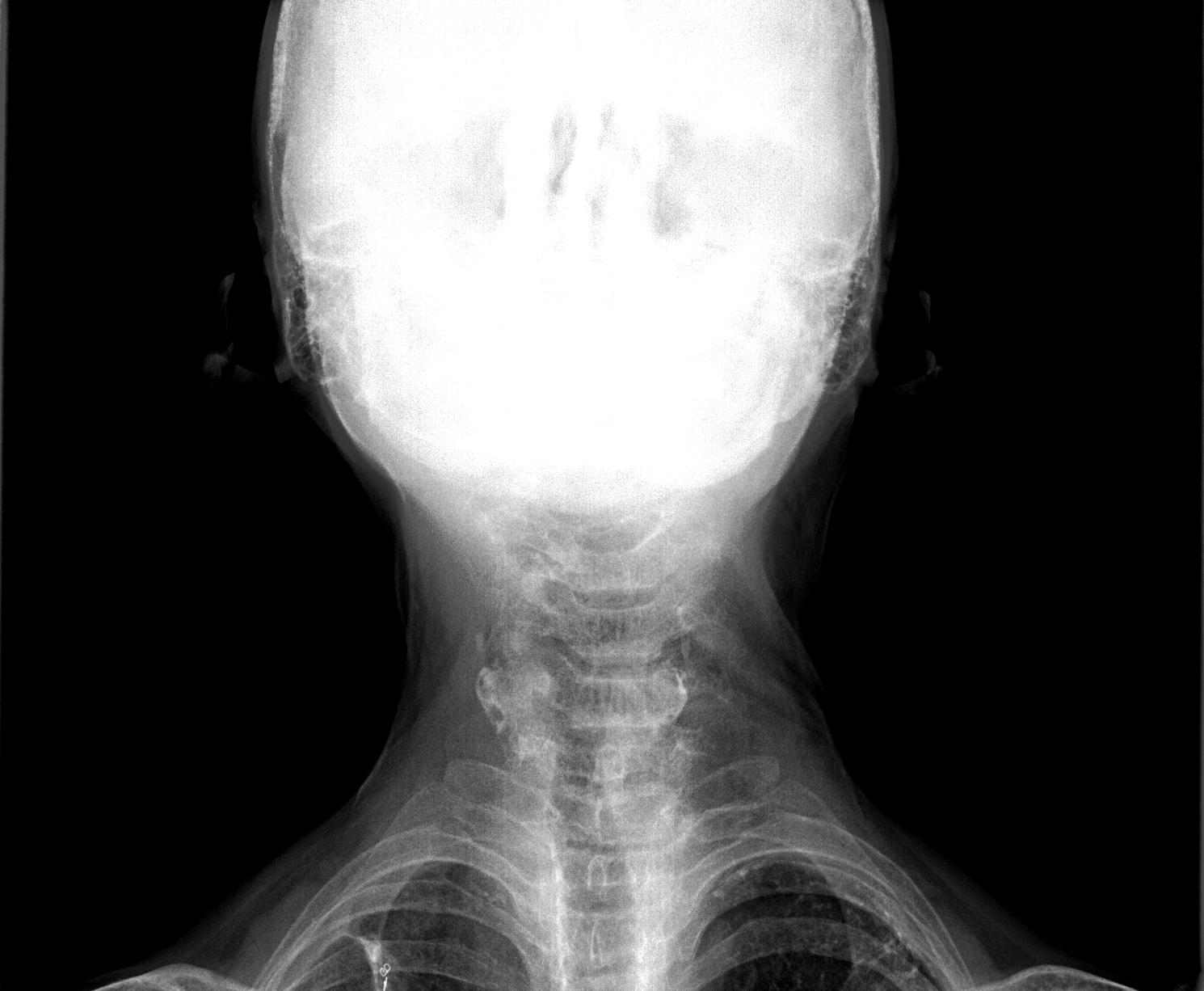 Обызвествление щитовидного хряща на рентгене