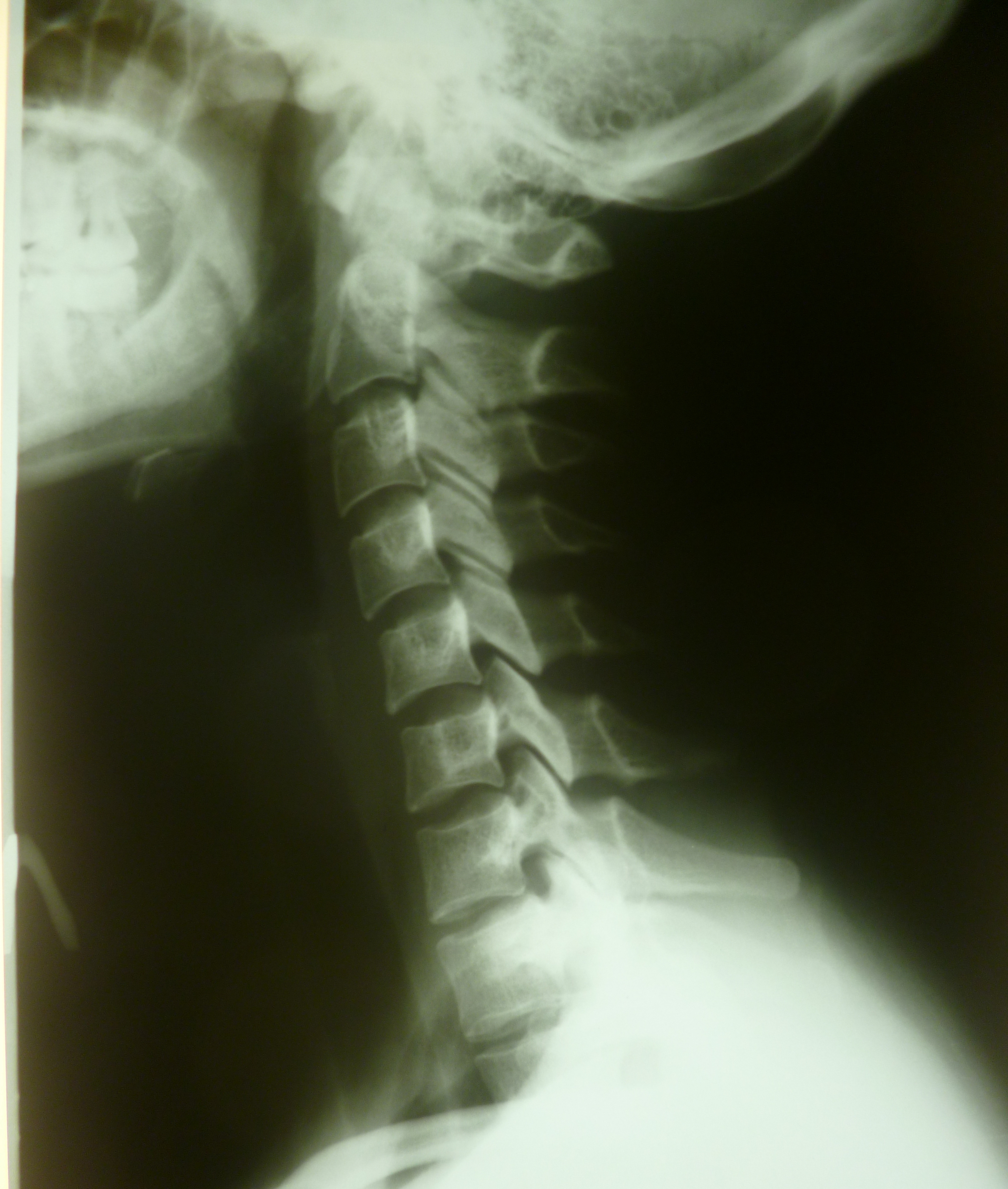 Смещение шейных позвонков. Подвывих с4-5 с5-6. Подвывих с1 позвонка. Подвывих с1 позвонка рентген. Спондилолистез с2-с5.