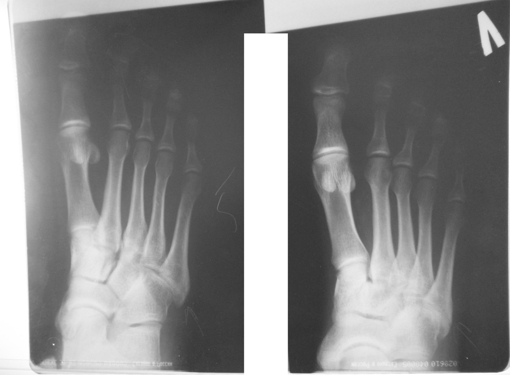 Перелом 5 плюсневой кости стопы без смещения фото до и после
