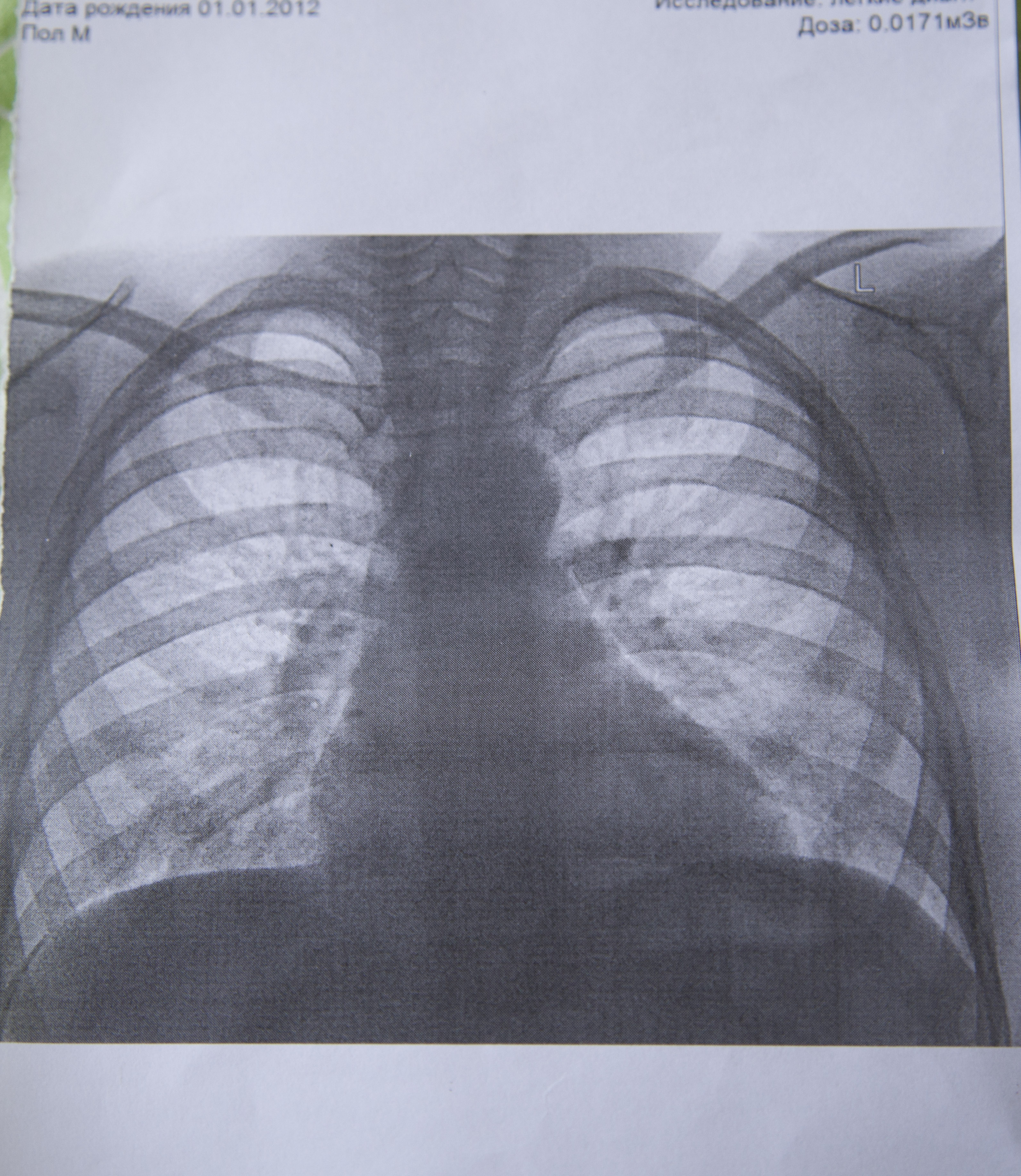 Делают рентген грудной клетки ребенку. Рентген грудной клетки ребенка 6 лет. Рентгенограмма грудной клетки у детей. Рентген грудной клетки ребенку год. Рентген грудной клетки ребенка 7 лет.