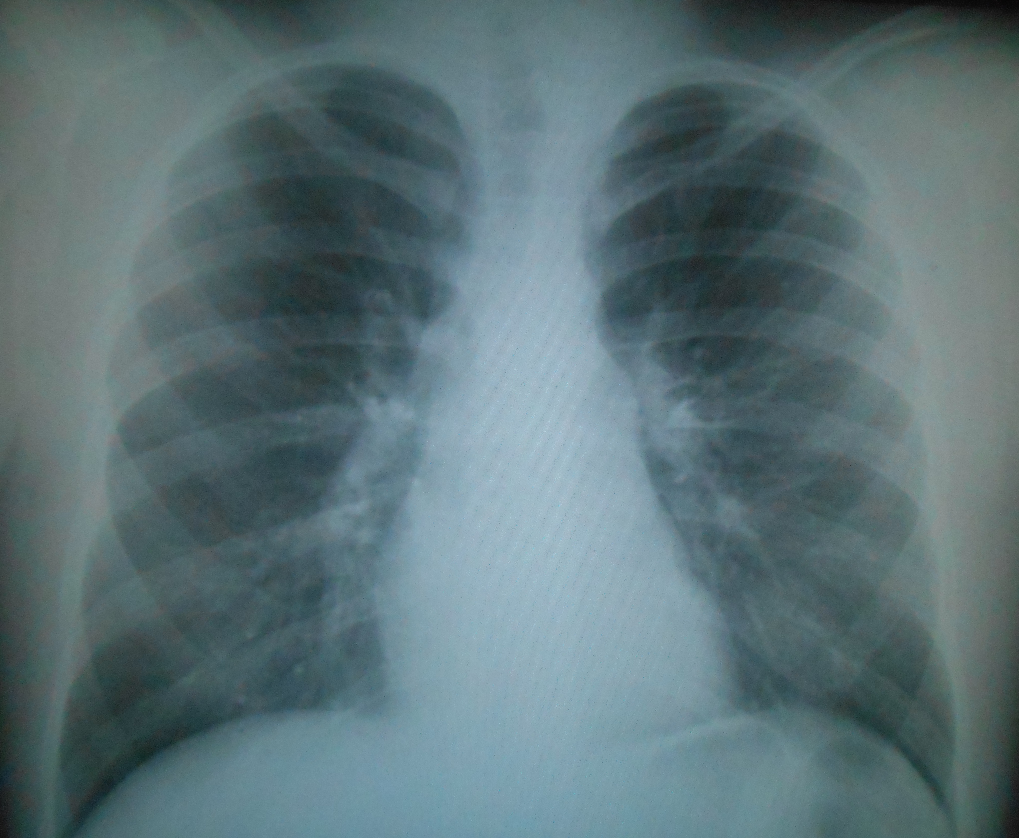 Обзорная рентгенография легких