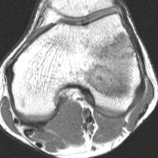 Отек костного мозга латеральных мыщелков. Перифокальный отек костного мозга коленного сустава. Отек костного мозга надколенника. Отек костного мозга мрт. Костный отек надколенника.