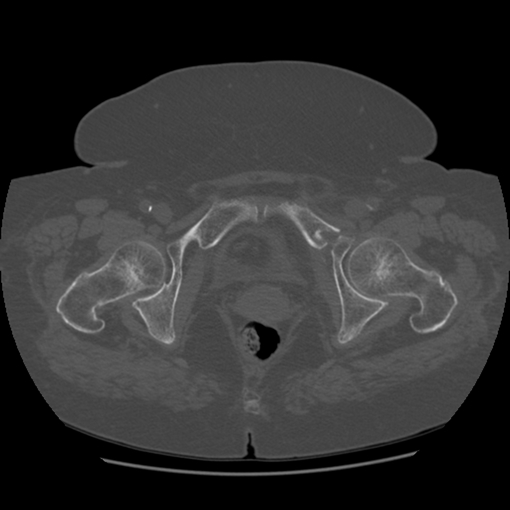 Кт подвздошной кости