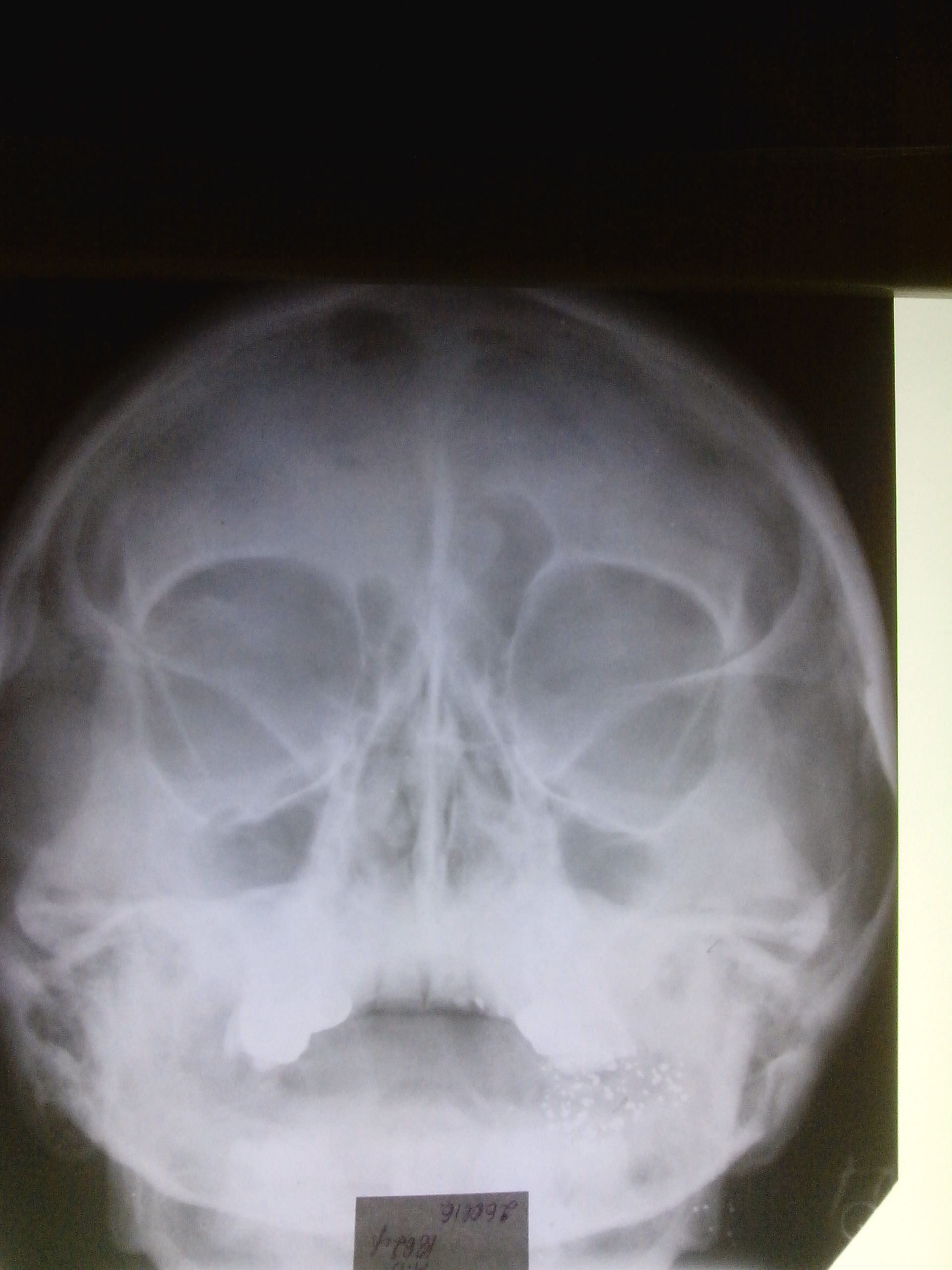 Киста в лобной доле. Остеома левой лобной пазухи на рентгене. Остеома верхнечелюстной пазухи рентген. Остеома верхнечелюстной пазухи кт.