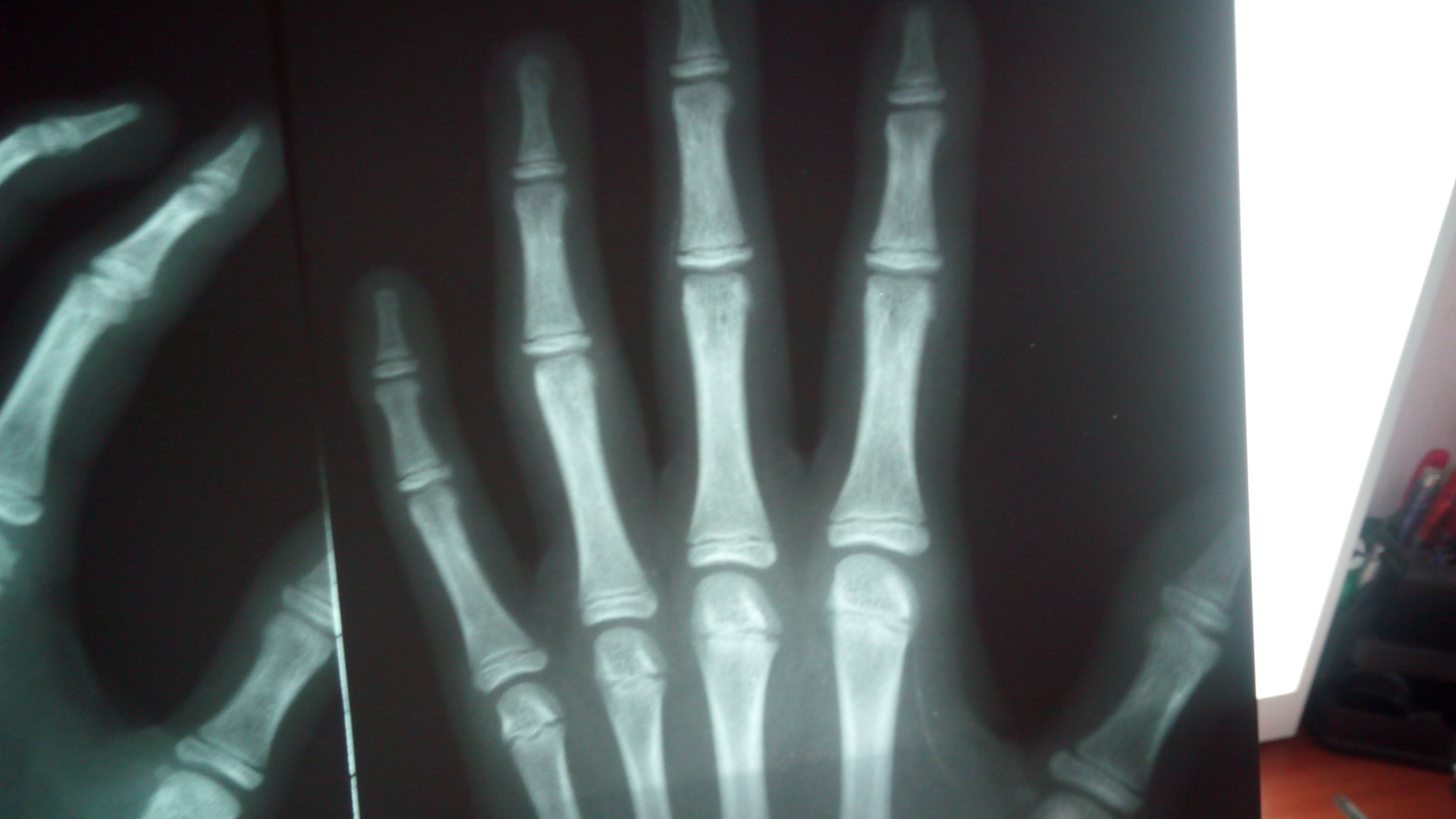 Открытый перелом фаланги. Перелом проксимальной фаланги 4 пальца. Перелом проксимальной фаланги 4 пальца стопы. Перелом 4 фаланги пальца кисти. Проксимальной фаланги 4 пальца на руке.