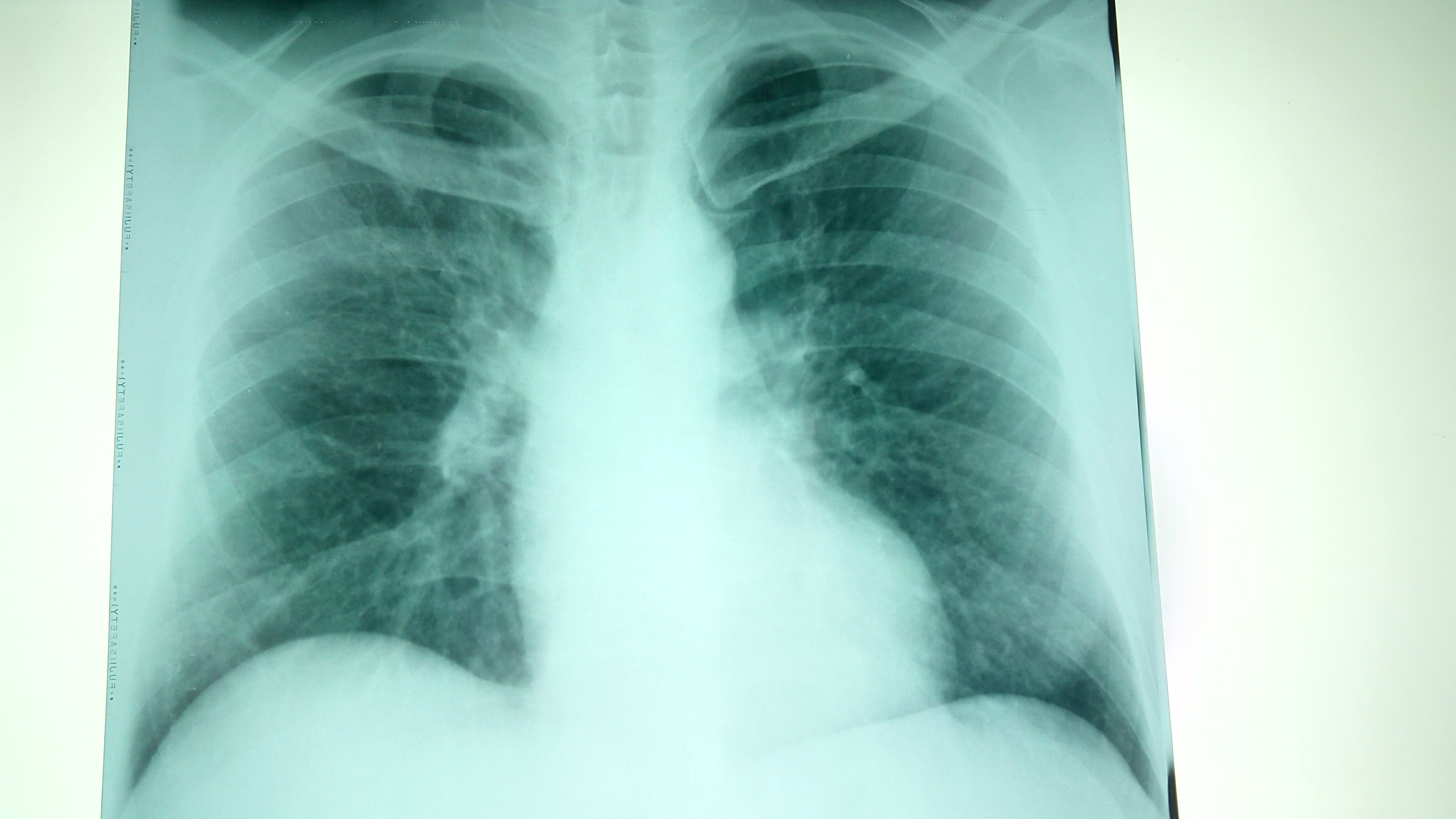 Do not ignore it .. 5 main signs indicating that you have lung cancer! - Archyde