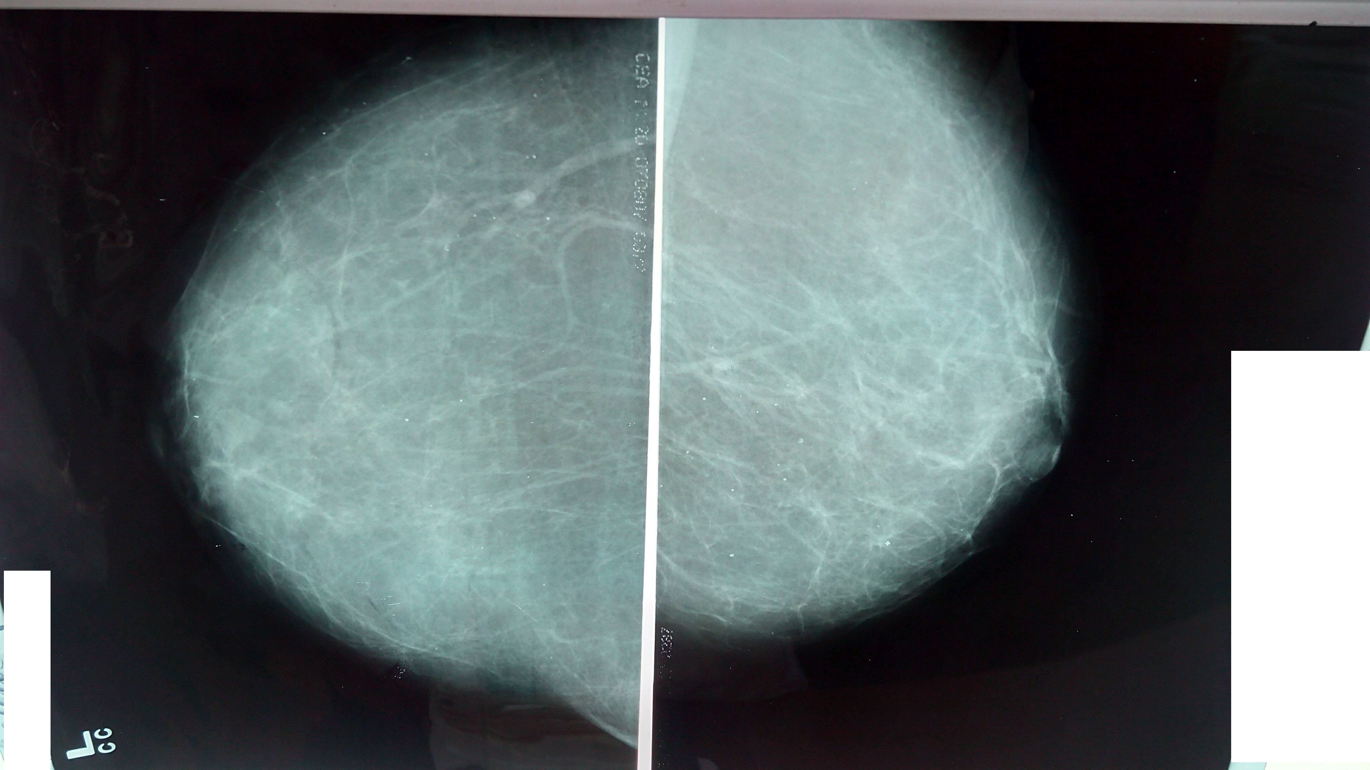 Как выглядит опухоль молочной железы на маммографии фото злокачественная