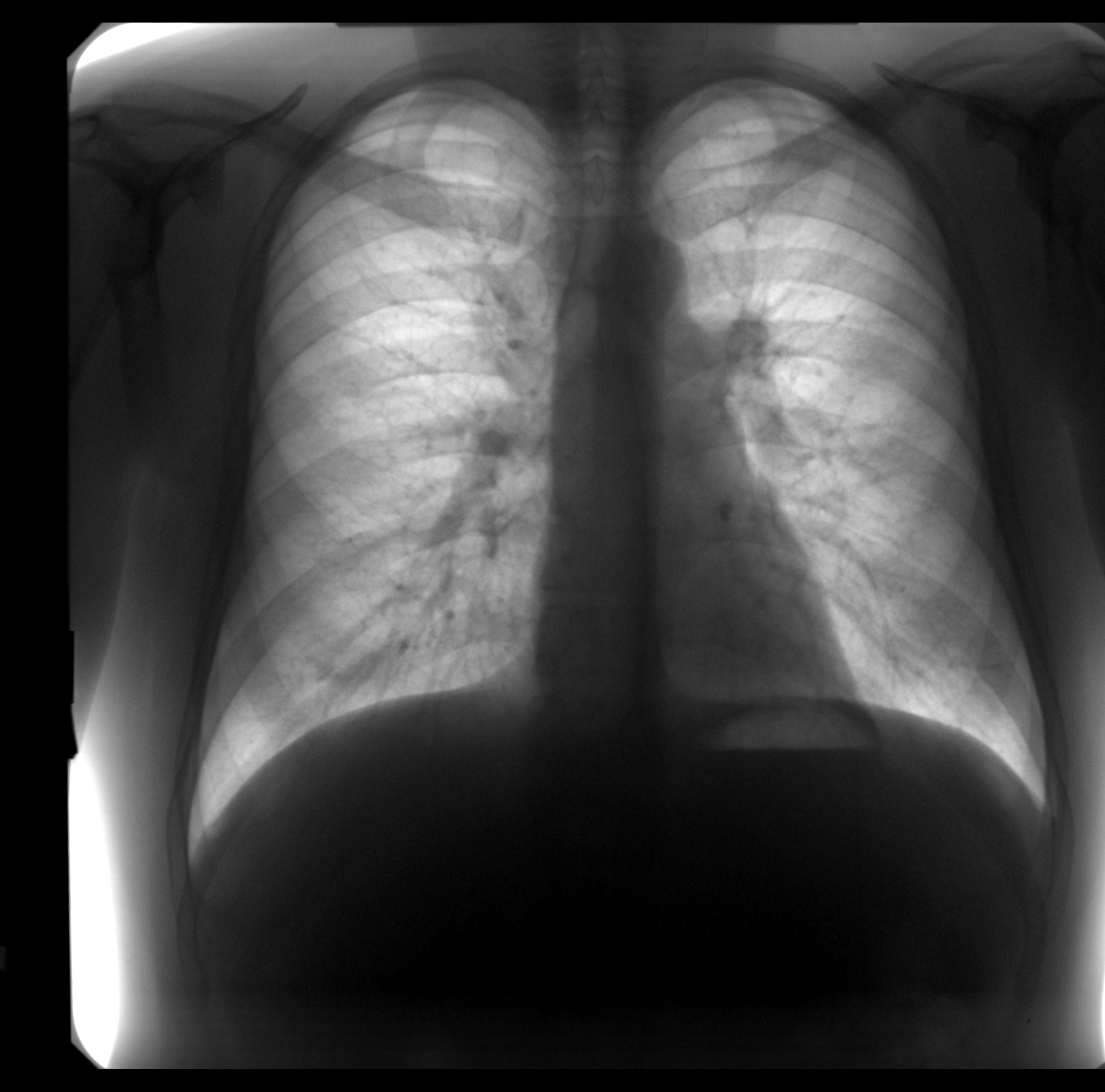 Поражение тканей легких. Инфильтративный туберкулез. Инфильтративный туберкулез легкого рентген. Флюорограмма туберкулеза.