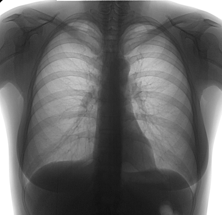 Флюорография грудной. Снимок флюорографии. Снимок ФЛГ. Снимки ФЛГ.