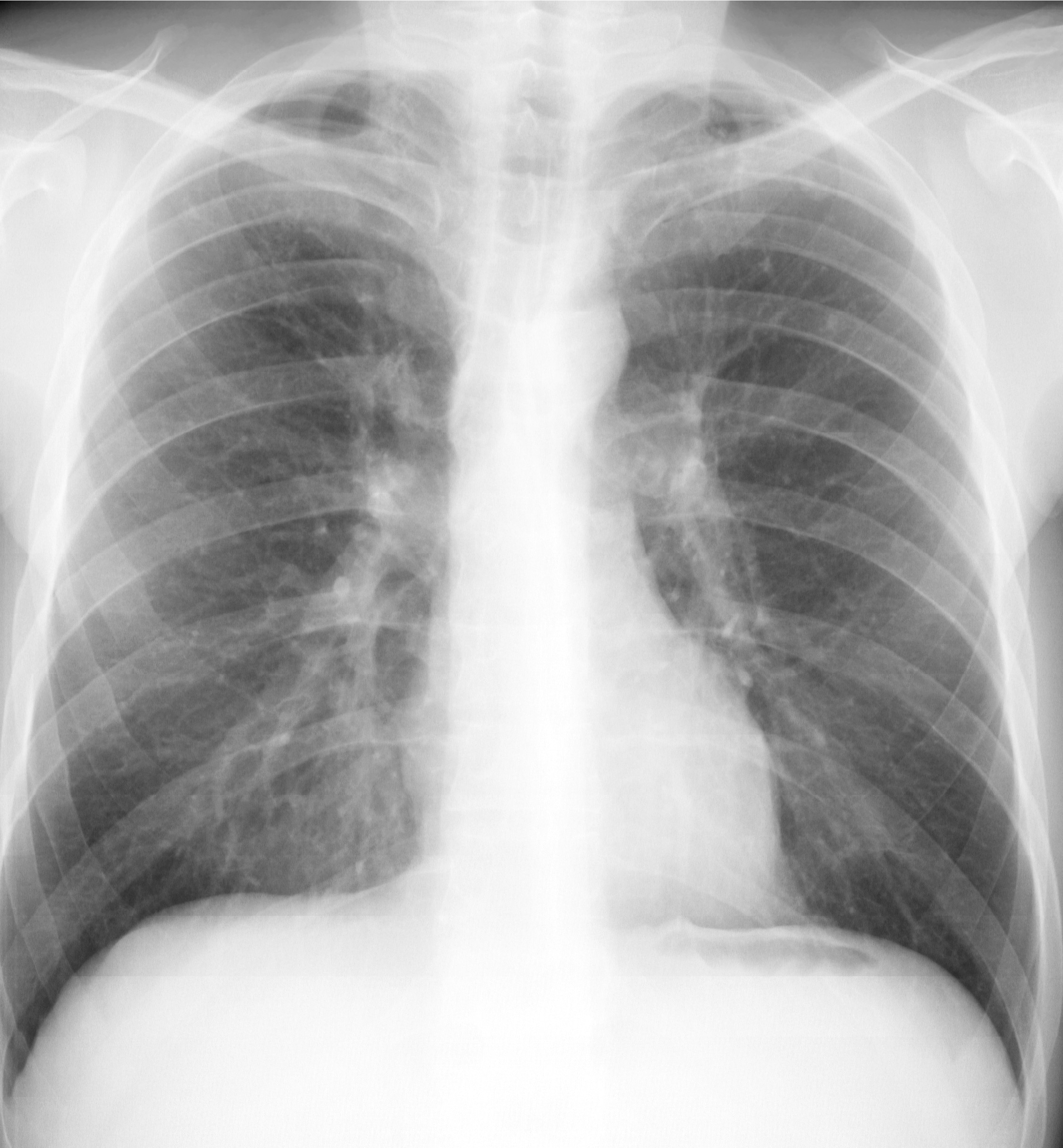 Дольковая пневмония рентген