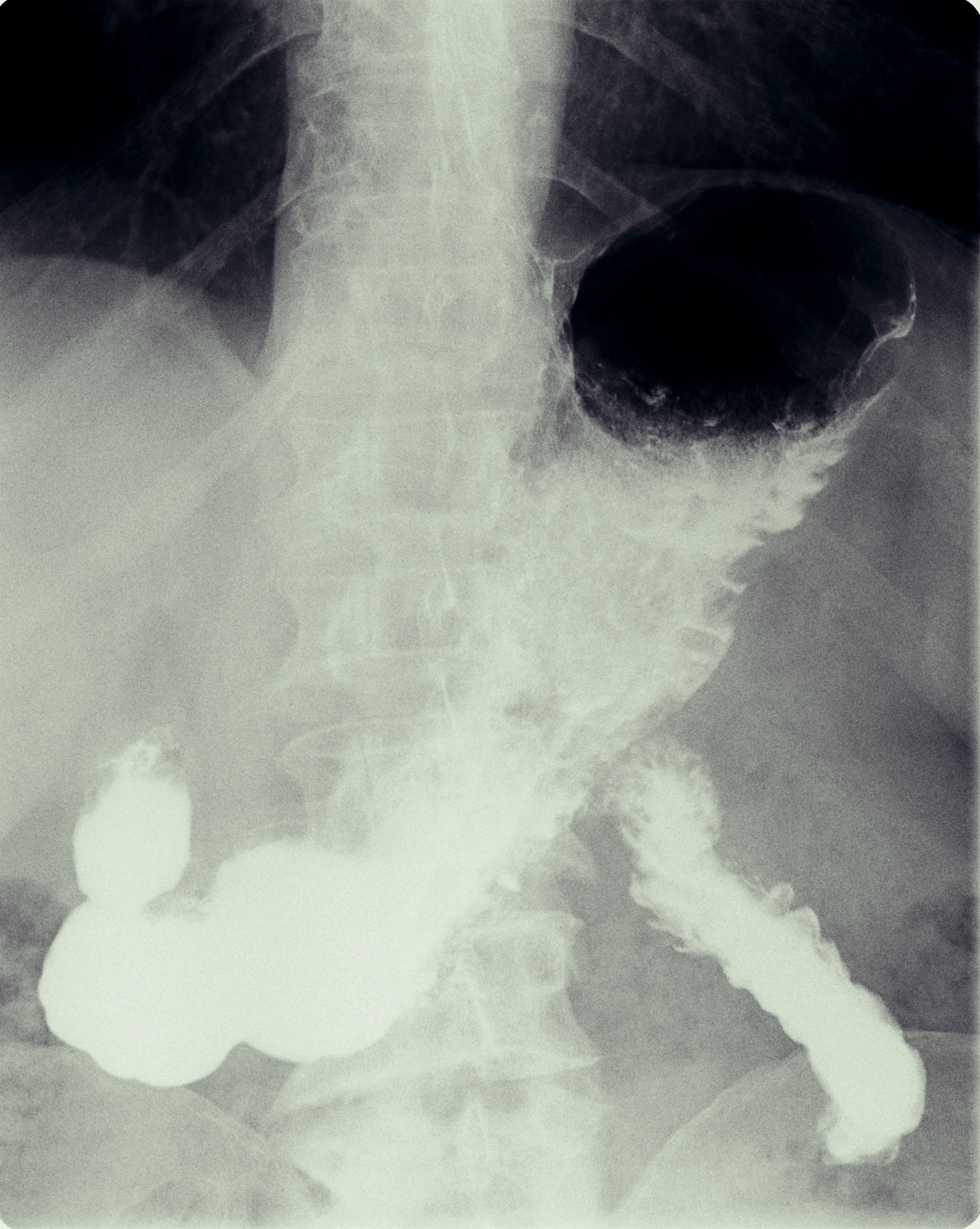 Рентген с барием пищевода и желудка подготовка. Рентгеноскопия желудка и ДПК. Рентгеноскопия желудка с барием норма. Рентгеноскопия желудка и пищевода. Рентген ЖКТ С барием в норме.
