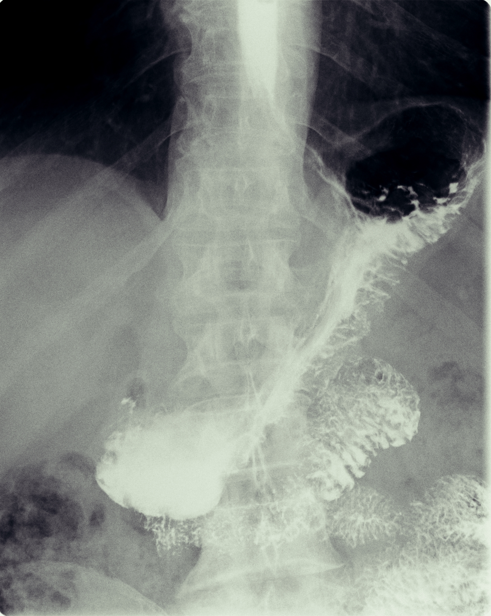 Рентген с барием пищевода и желудка подготовка. Каскад желудка рентген. Каскадная деформация желудка на рентгене. Каскадный желудок рентген. Каскадный Перегиб желудка рентген.