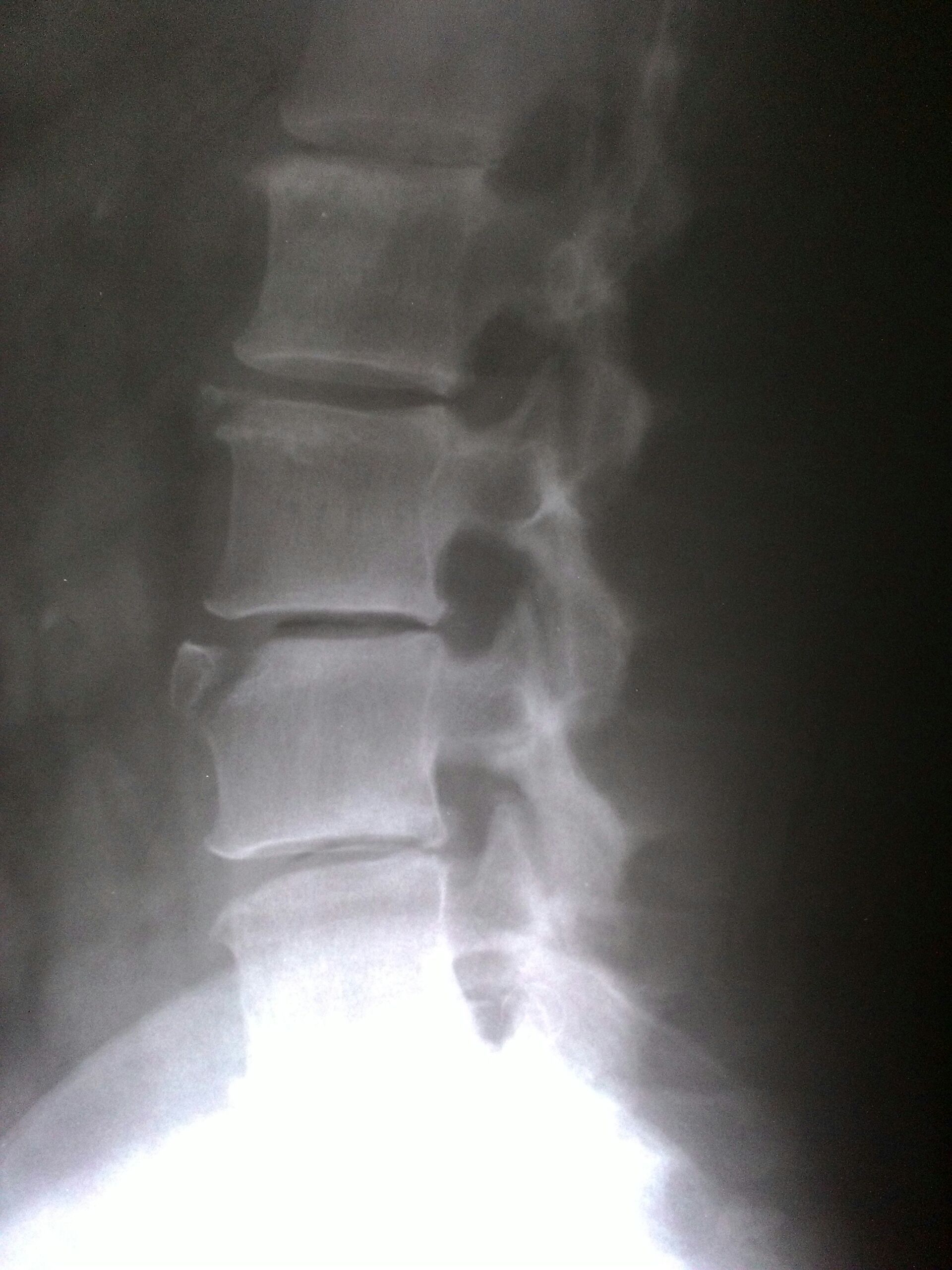 Остеофиты позвоночника. Остеофиты l3-l5. Остеофиты на рентгене позвоночника. Остеофиты шейного отдела позвоночника рентген. Краевые остеофиты на рентгене.