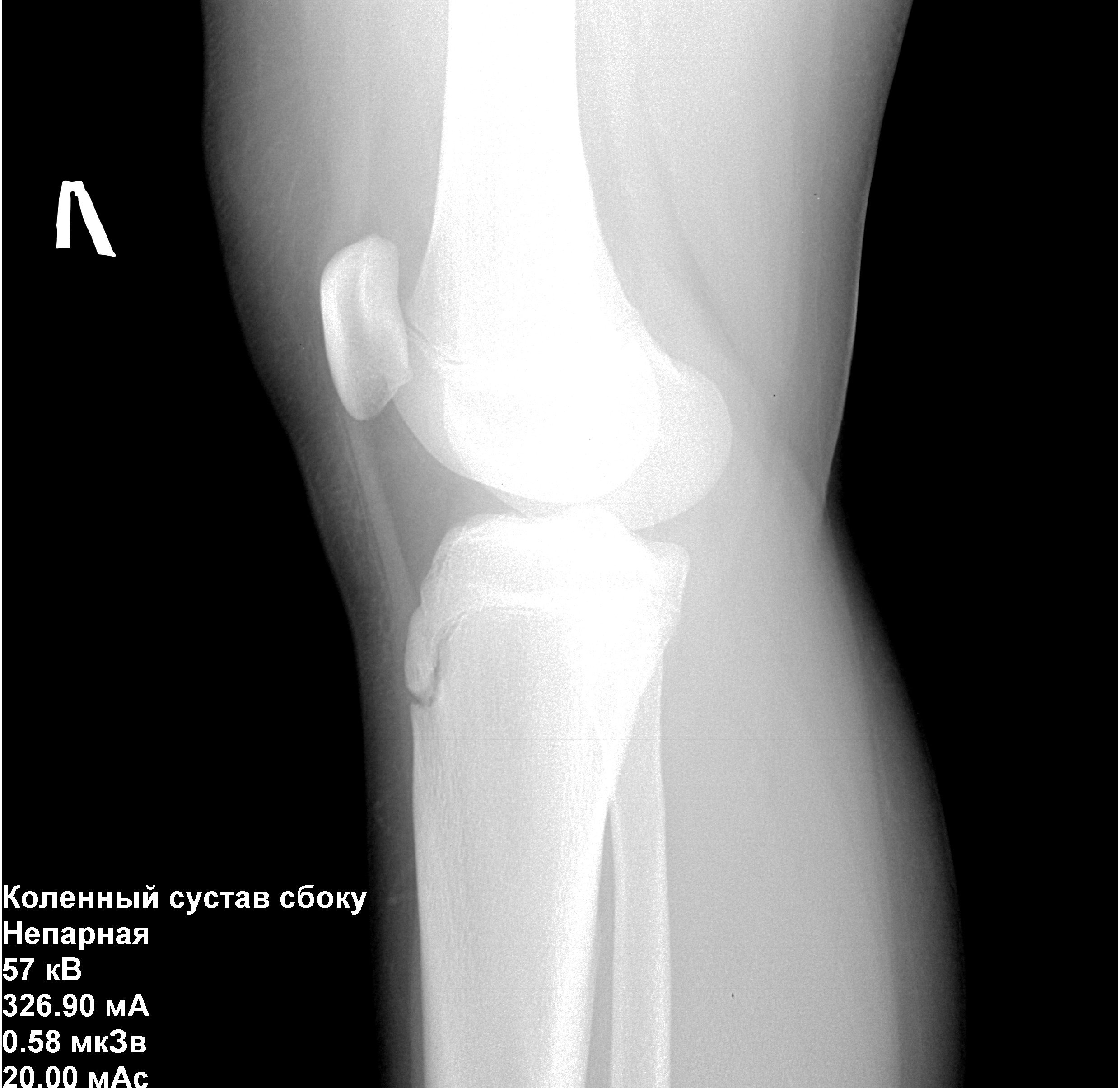 Рентген колена. Коленный сустав рентген норма. Рентген коленной чашечки в норме. Рентгенограмма коленного сустава в норме. Рентген коленки сбоку.