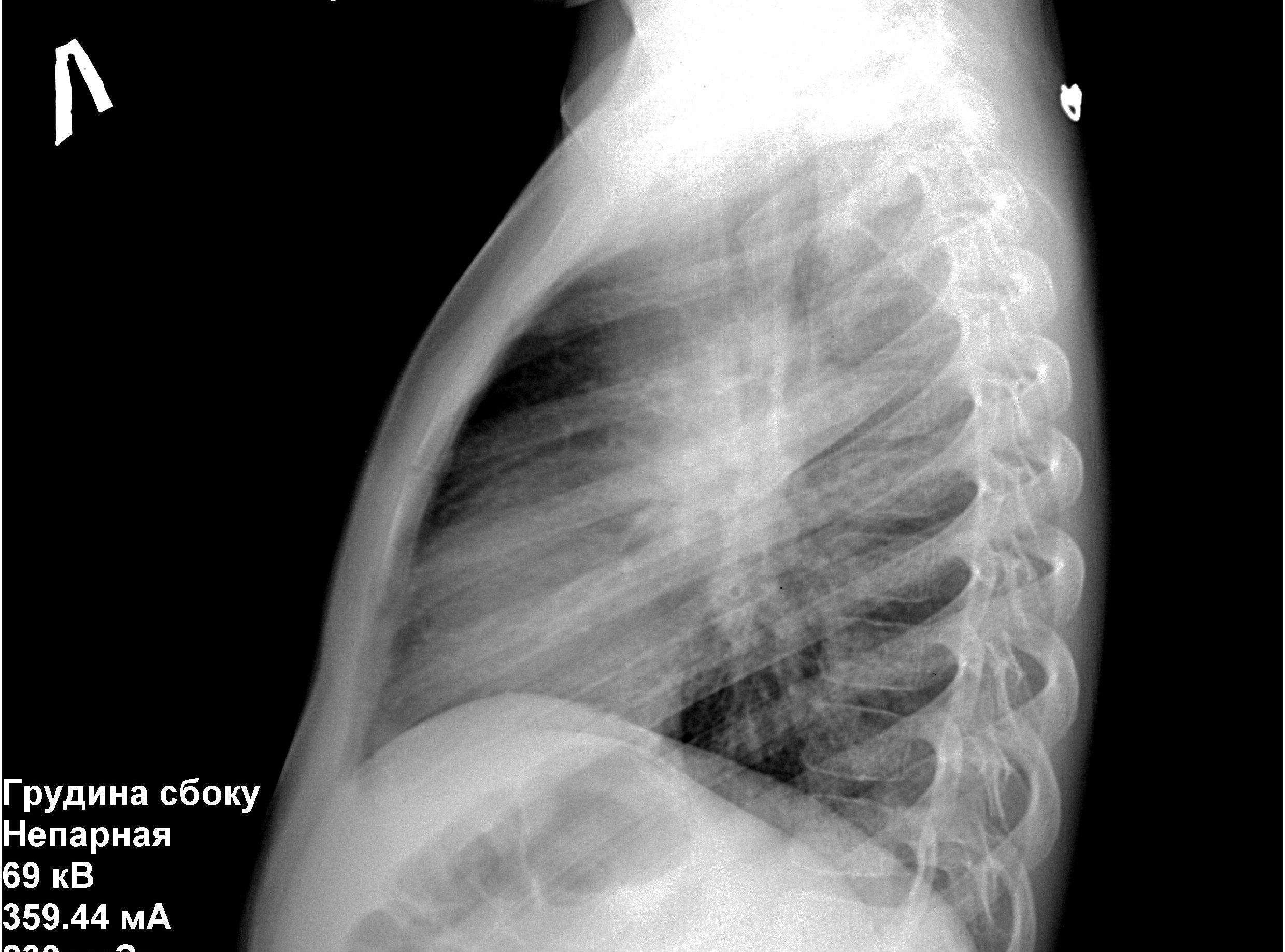 Рентгенограмма в боковой проекции