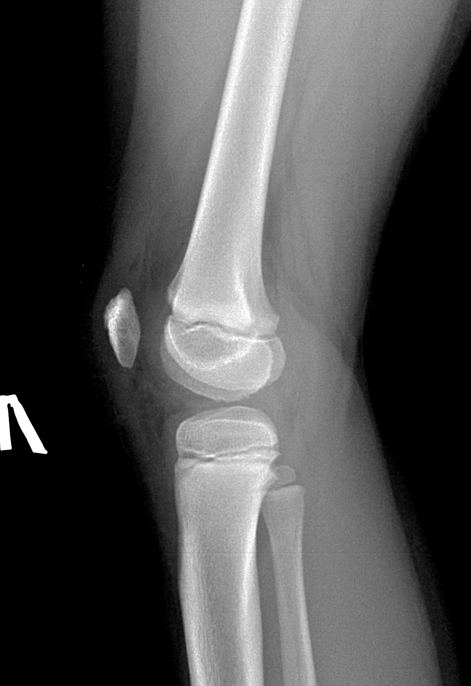 Колена 21 год. Коленные суставы 9 лет рентген. Рентгенограмма коленного сустава ребенка. Коленный сустав рентген норма. Надколенник рентген в 4 года.