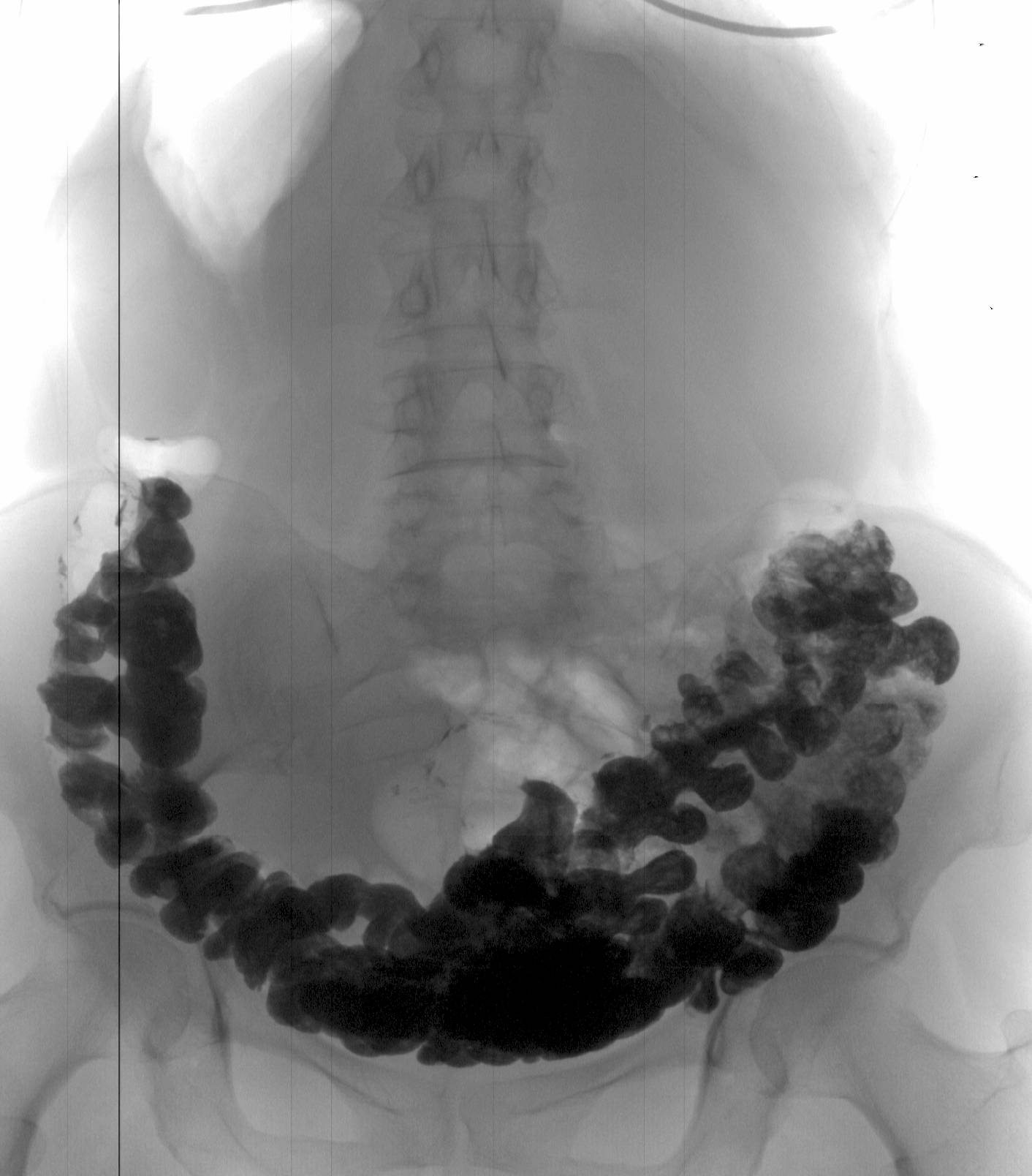 Толстый кишечник каловые камни рентген