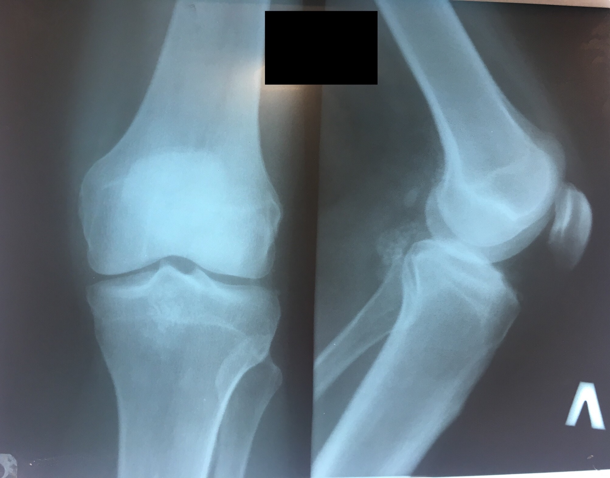 Синовит коленного сустава рентген