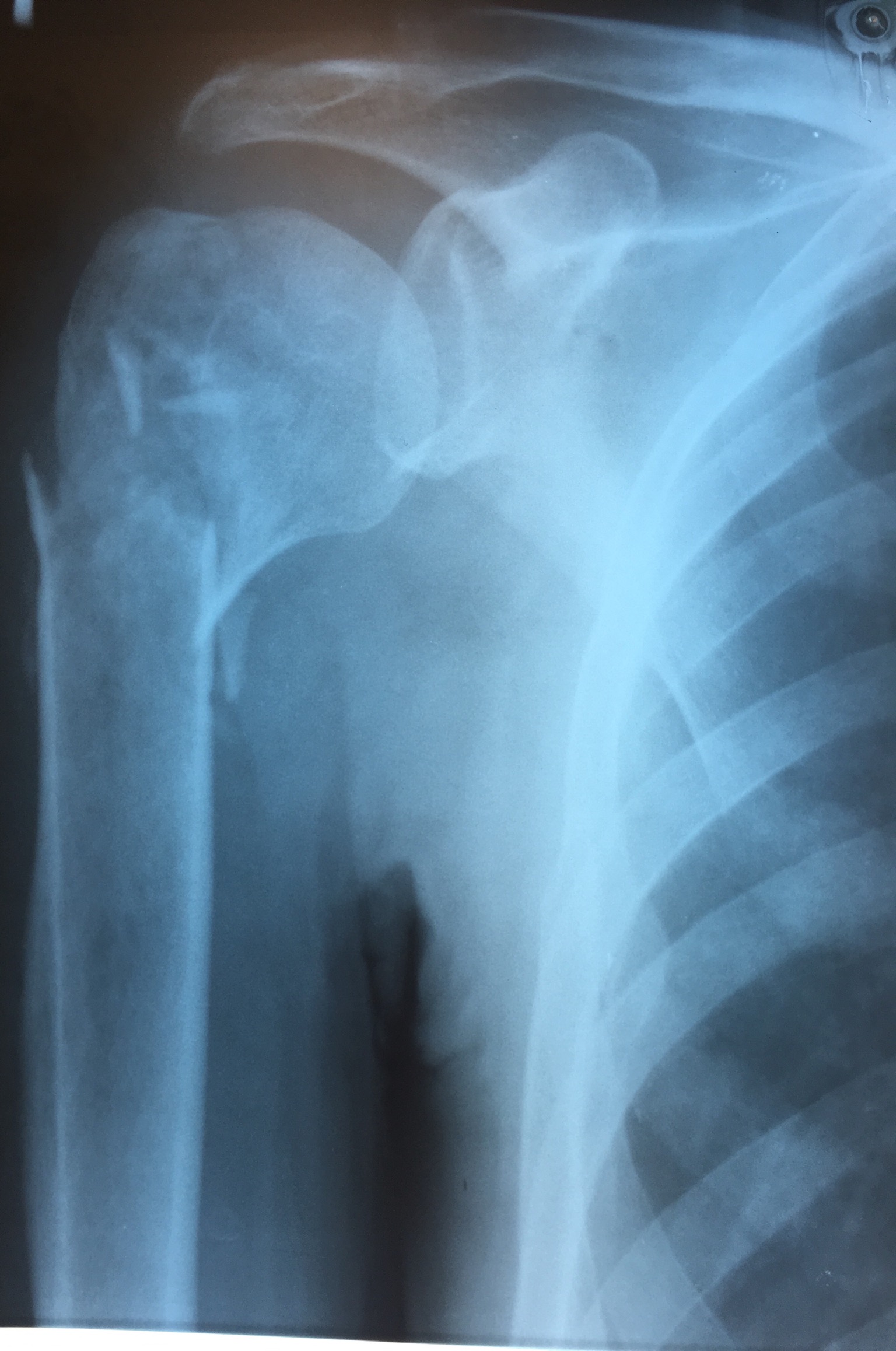 Перелом плечевого сустава рентген