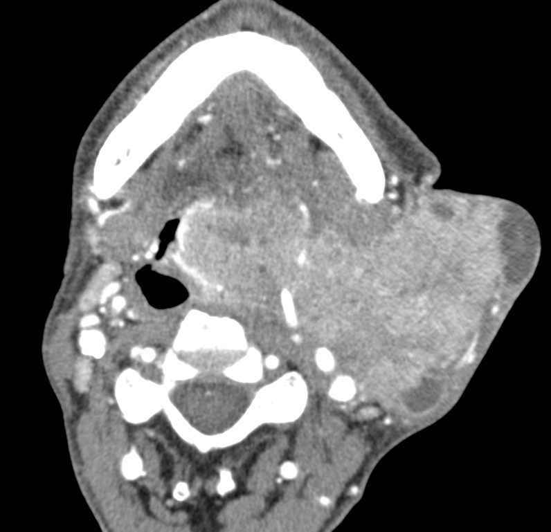 Кт шеи. Лимфома кистозная (шеи на кт.