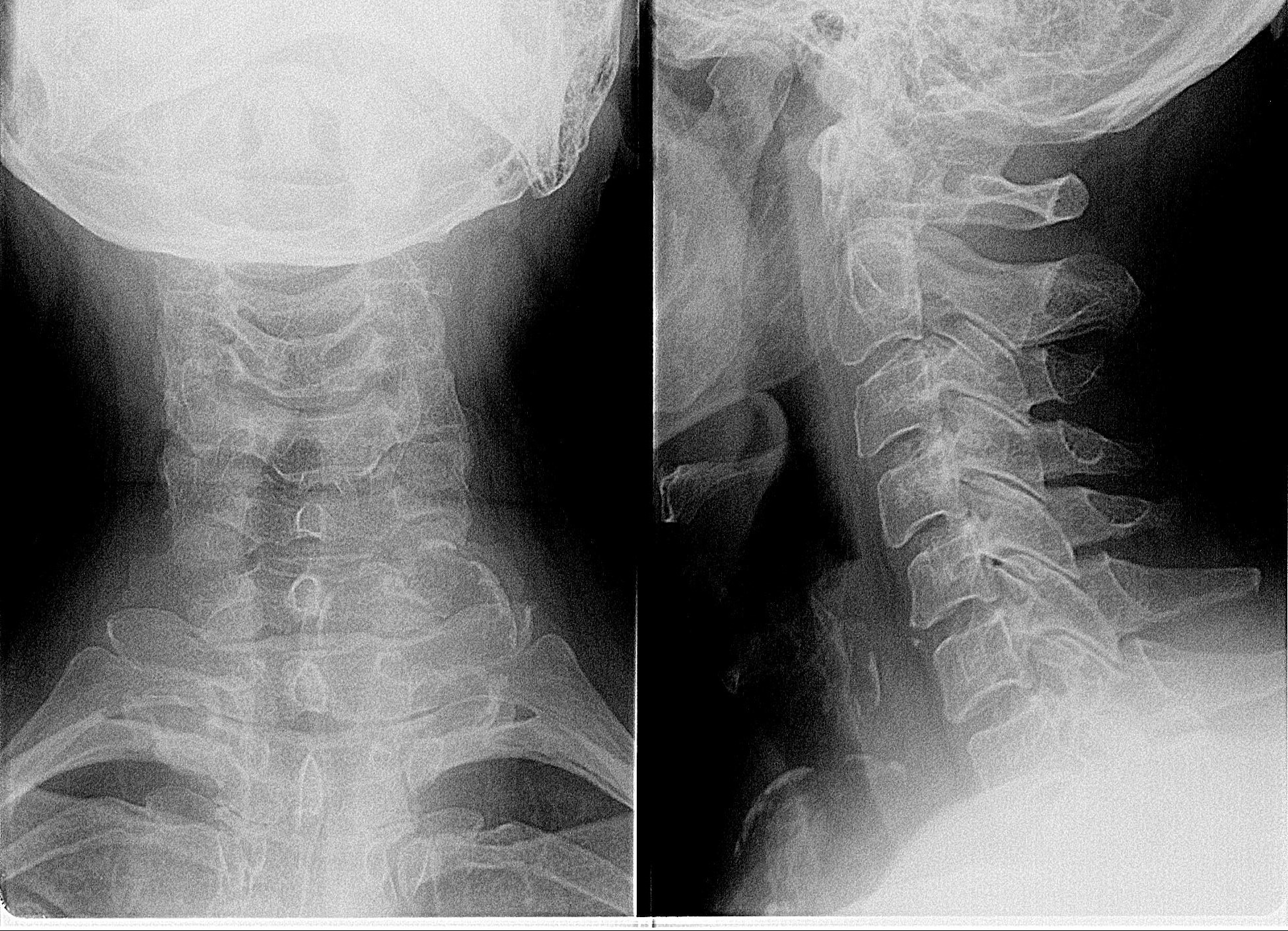 Рентгенография отдела позвоночника. Остеофиты шейного отдела позвоночника Рент. Остеофиты на рентгене шейного отдела. Остеофиты шейного отдела рентгенография. Шейный отдел позвоночника нестабильность с7.