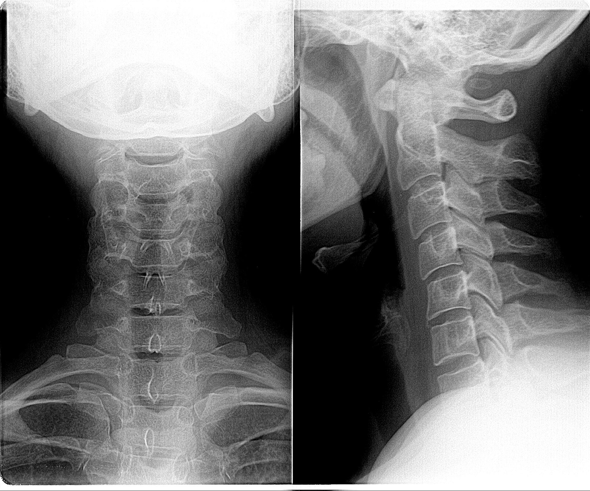 Рентгенография позвоночника. Шейный отдел позвоночника рентген 1с. Дисторсия шейного отдела рентген. Хлыстовая травма шейного отдела позвоночника рентген. Анкилоз шейного отдела рентген.