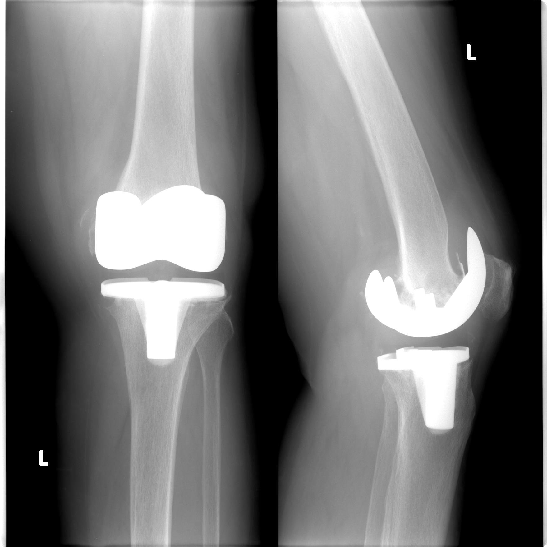 Тэп сустава. Эндопротезирование коленного рентген. Нестабильность коленного эндопротеза рентген. Эндопротезирование коленного сустава рентген. Эндопротезирование коленного сустава рентген нестабильность.