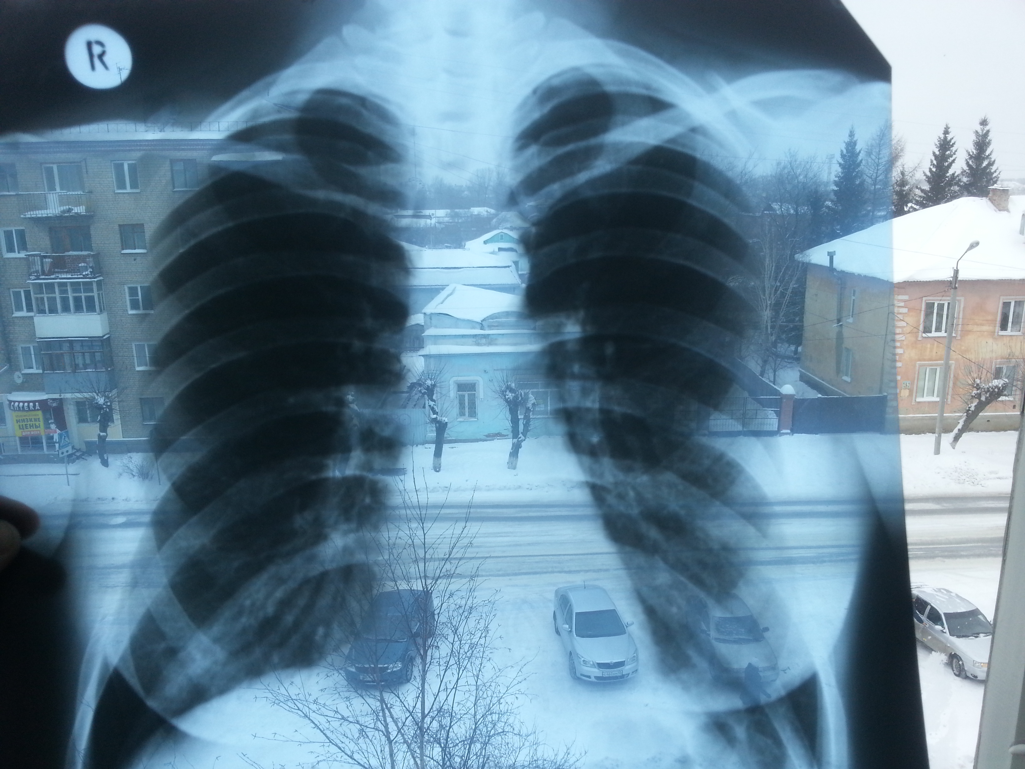 Пневмония на рентгене