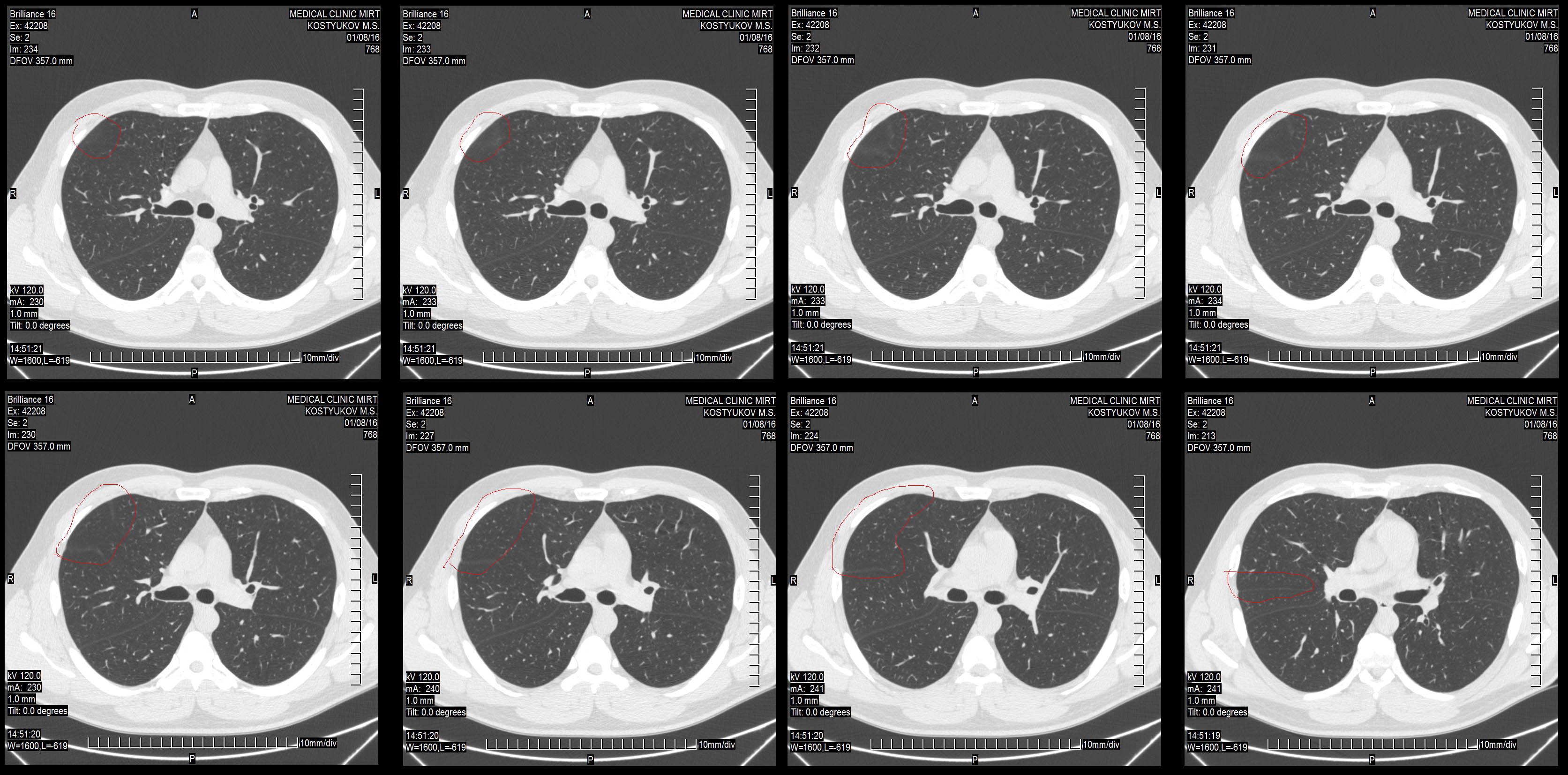 Кт огп. Компьютерная томография грудной клетки норма. Кт органов грудной клетки снимки. Кт грудной клетки сбоку. Кт грудной клетки норма.
