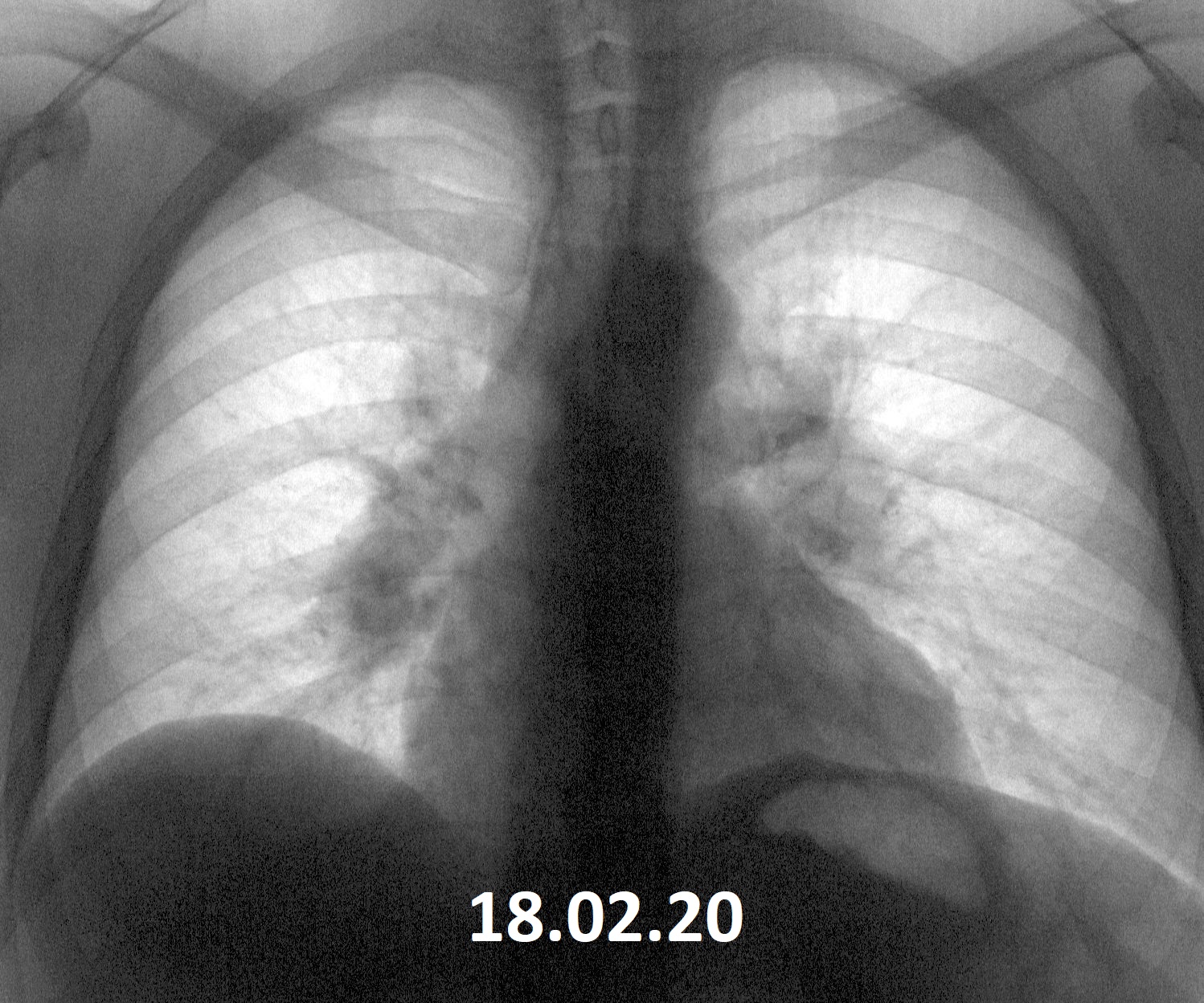 Парастернальная липома. Парастернальная липома рентген. Липома средостения рентген. Кардиодиафрагмальная липома рентген. Метастатический плеврит рентген.