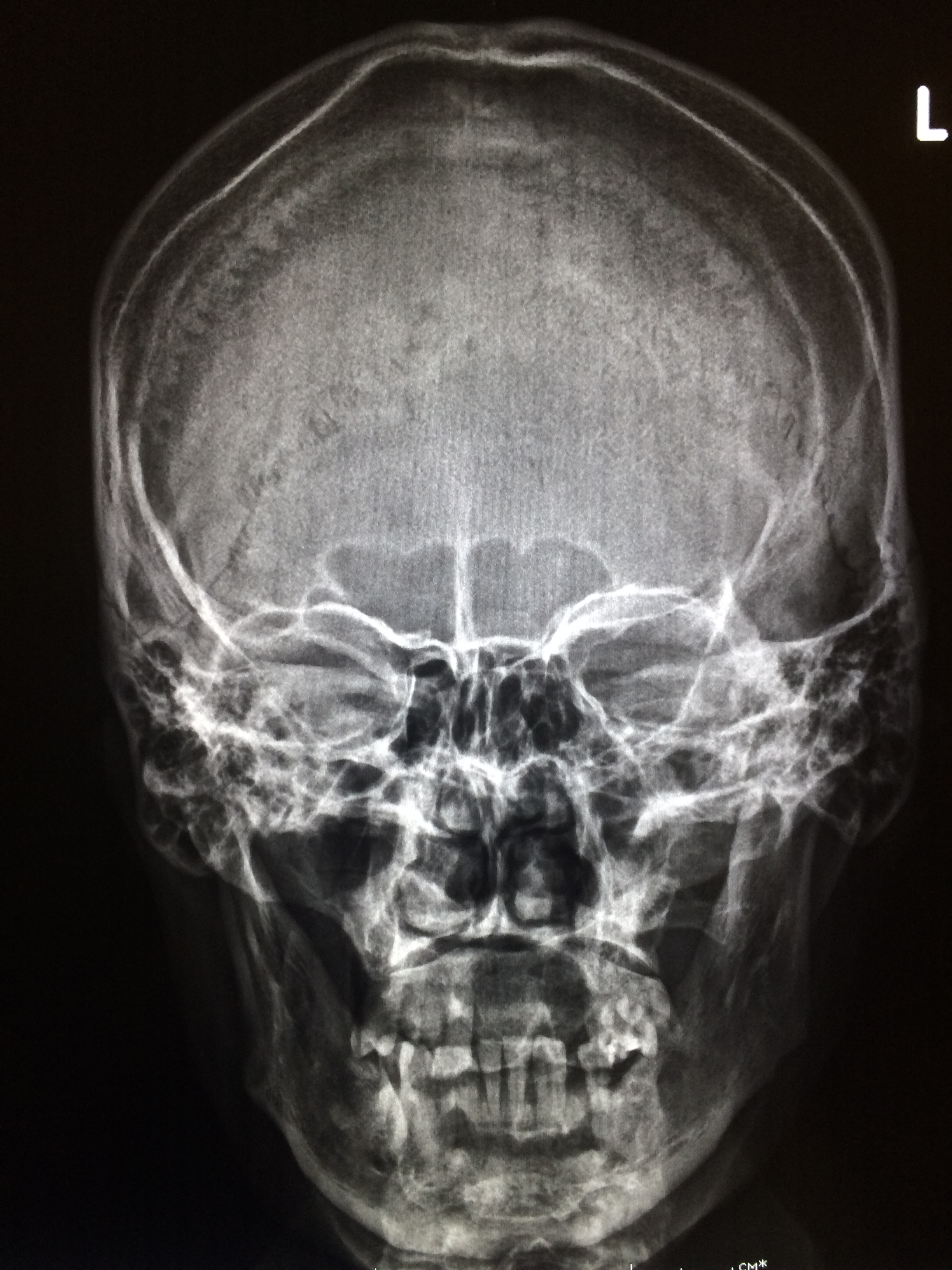 Снимок черепа. Кости черепа рентген норма. Снимок черепа сбоку кт. Рентгенография лицевого черепа.