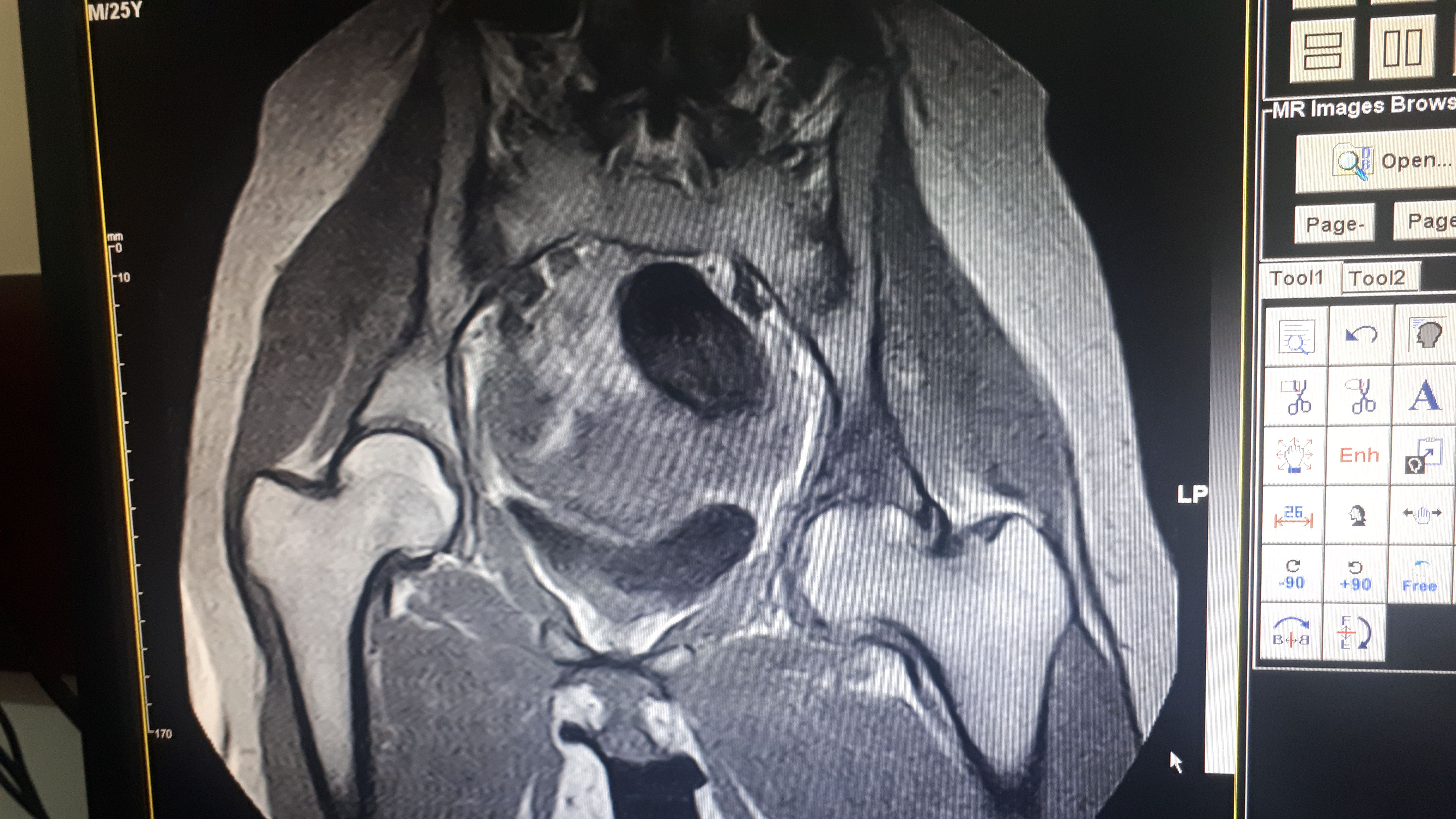 Мрт тазобедренного. Мрт снимок. Мрт тазобедренного сустава. Подвывих тазобедренного сустава мрт. Мрт снимки.