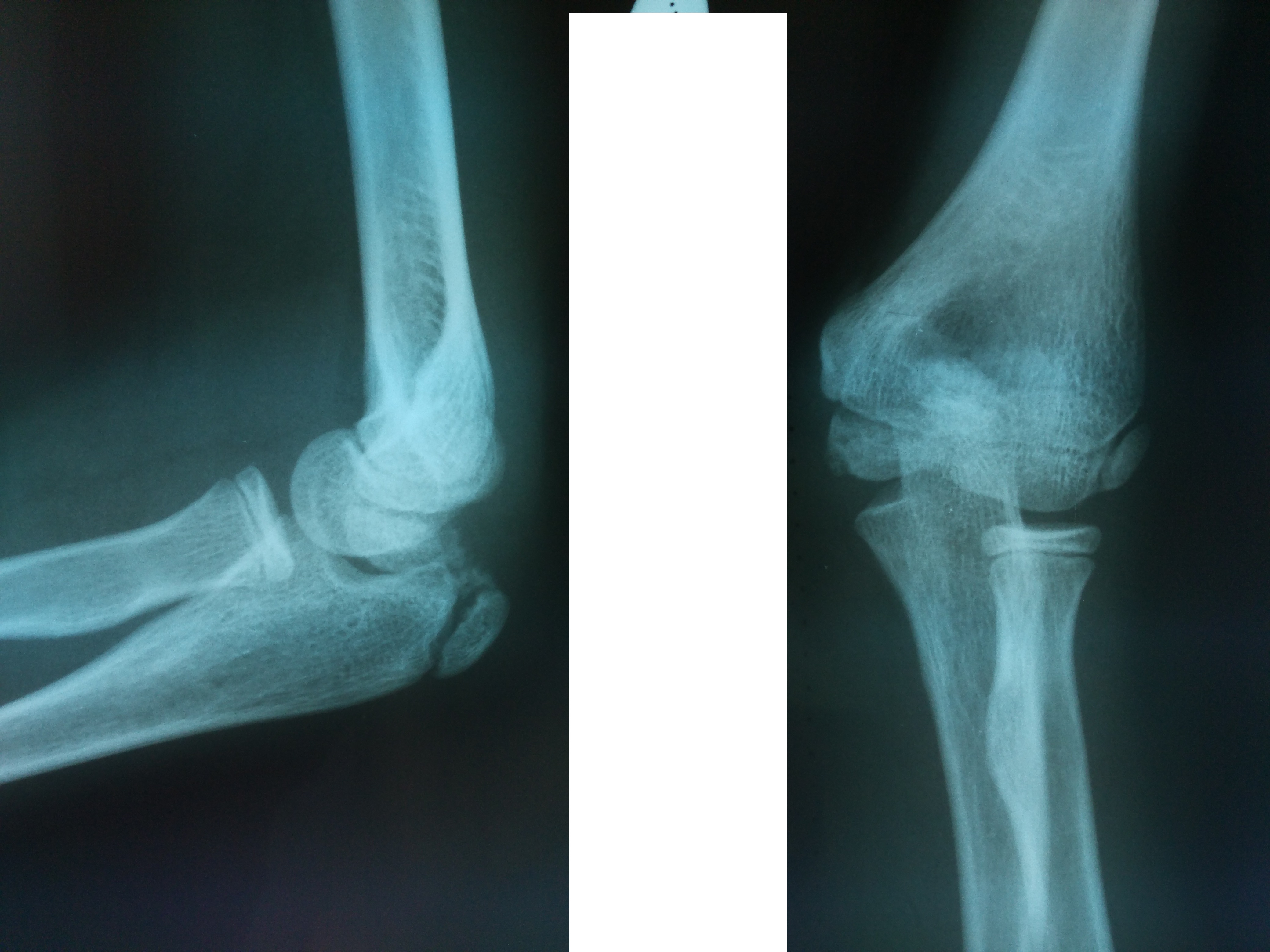 Перелом мыщелка локтевой кости рентген