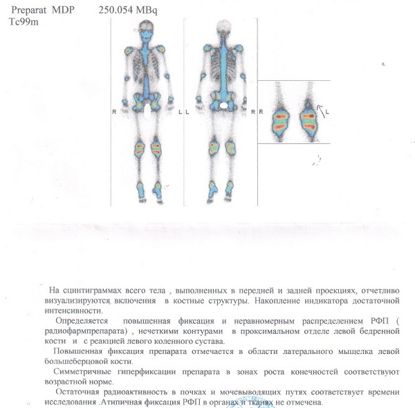 Гиперфиксация рфп что это такое. Модуль синтеза РФП схема. Что такое гиперфиксация РФП В костях.