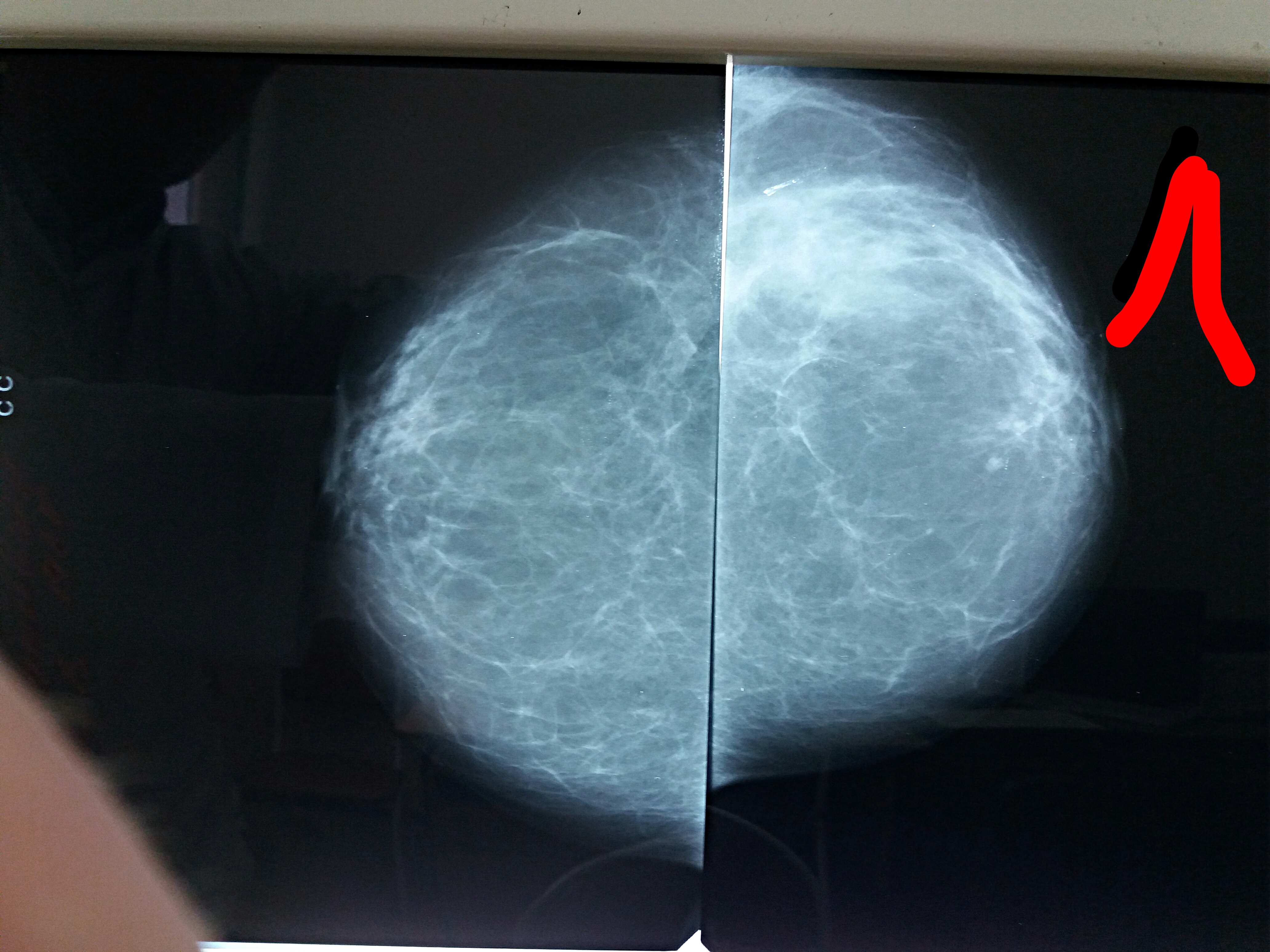 Фиброзные жировые изменения. Фиброаденома молочной железы маммография. Фибролипома маммография. Фиброзно жировая инволюция на УЗИ. Жировая инволюция молочных желез маммография.