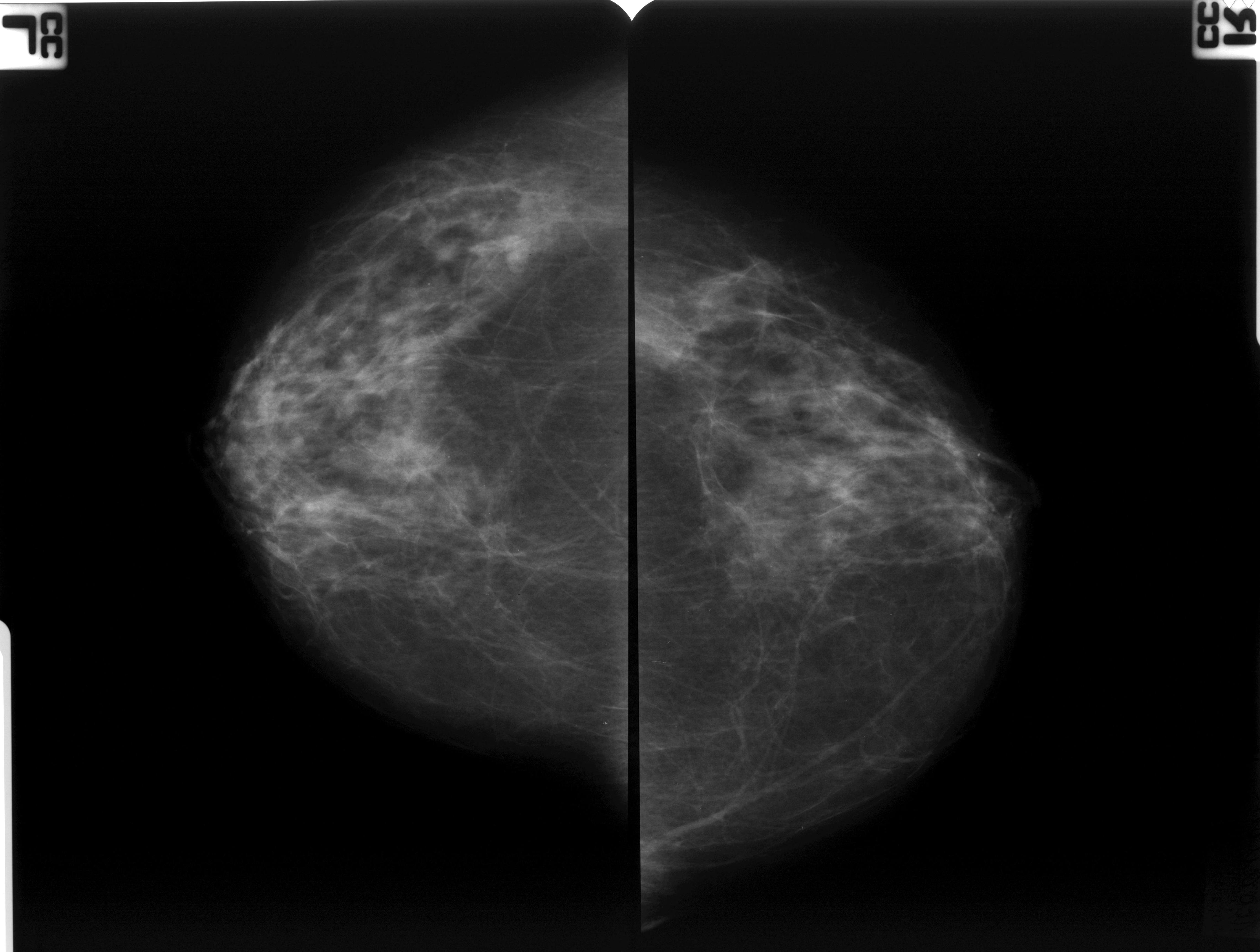 Маммография очаговая асимметрия
