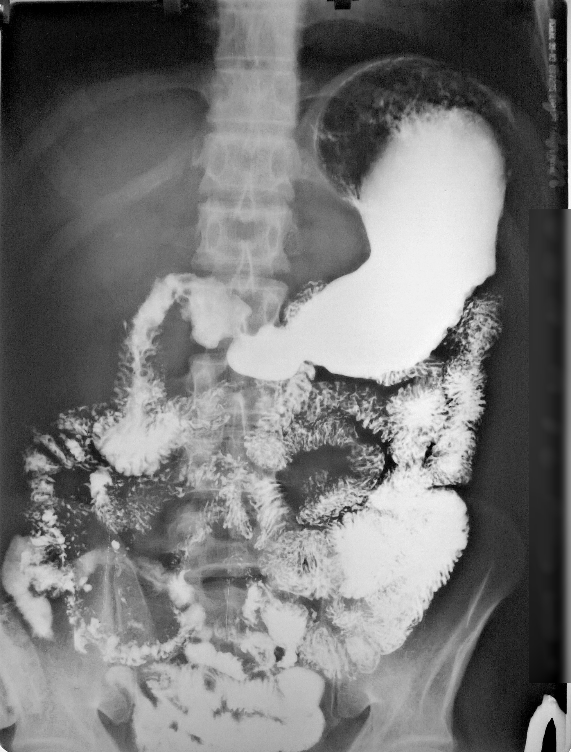 Рентген с контрастом. Рентген кишечника Пассаж барием. Пассаж бария по толстой кишке. Пассаж бариевой взвеси по ЖКТ.