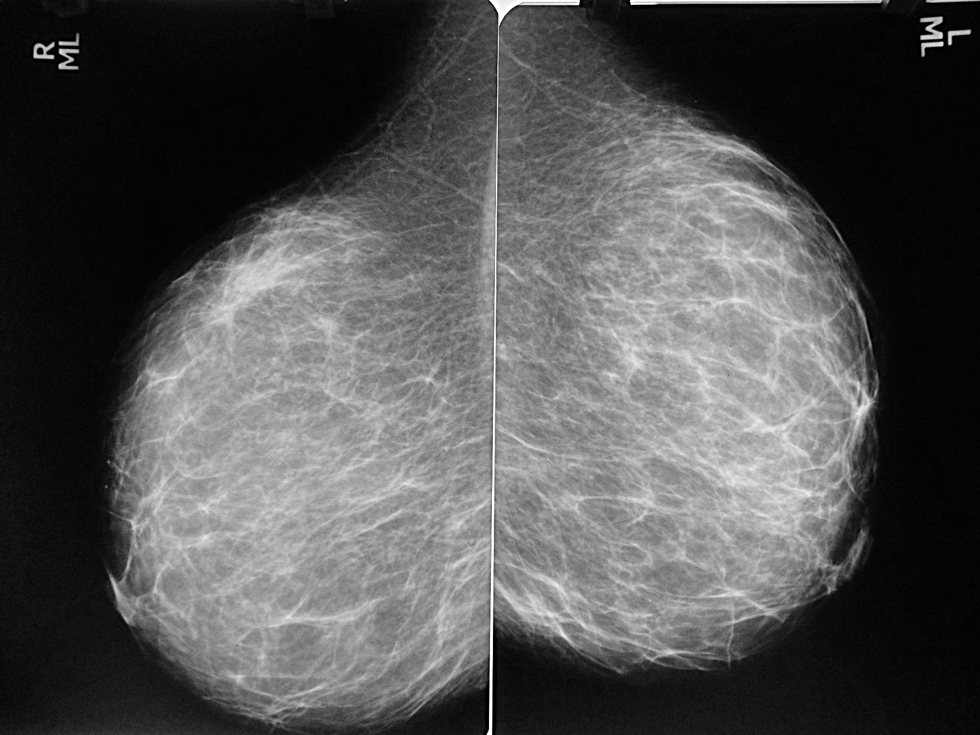 Маммография молочных желез 4. Рик молочной железы маммографич. Маммография рентген молочной железы. Маммография снимки норма. Маммограмма норма рентген.